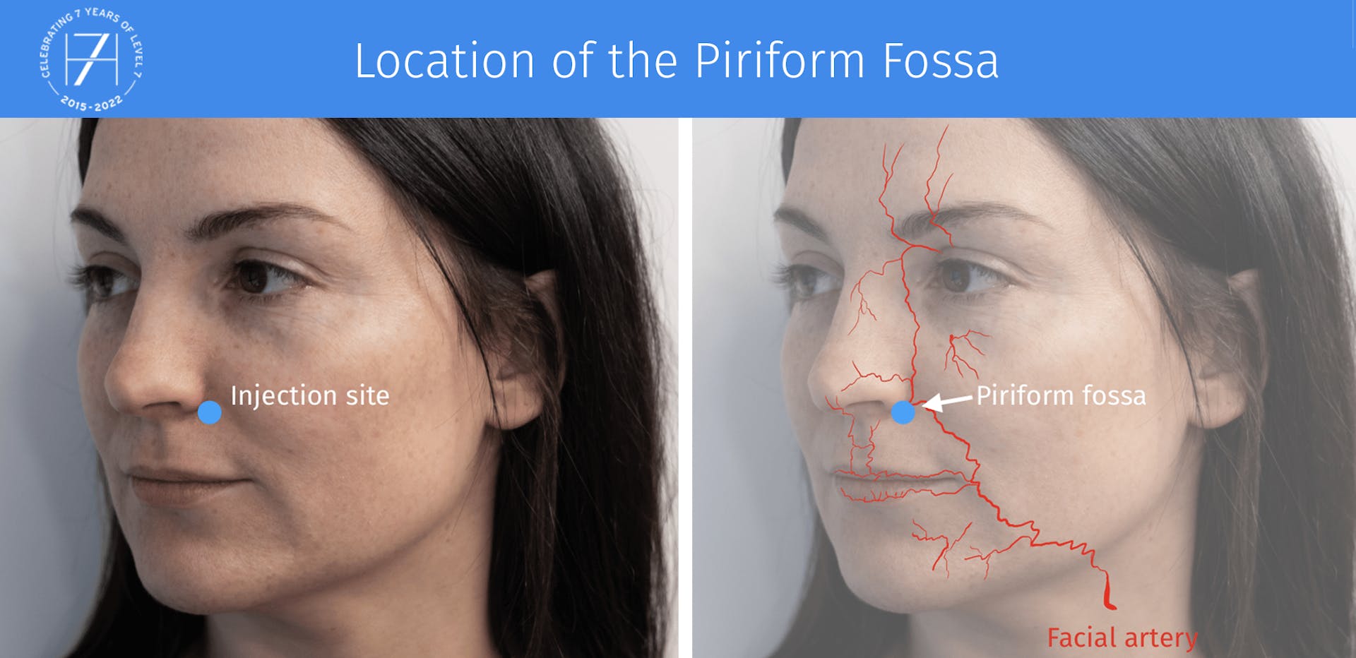Expert advice on Injecting the Piriform Fossa