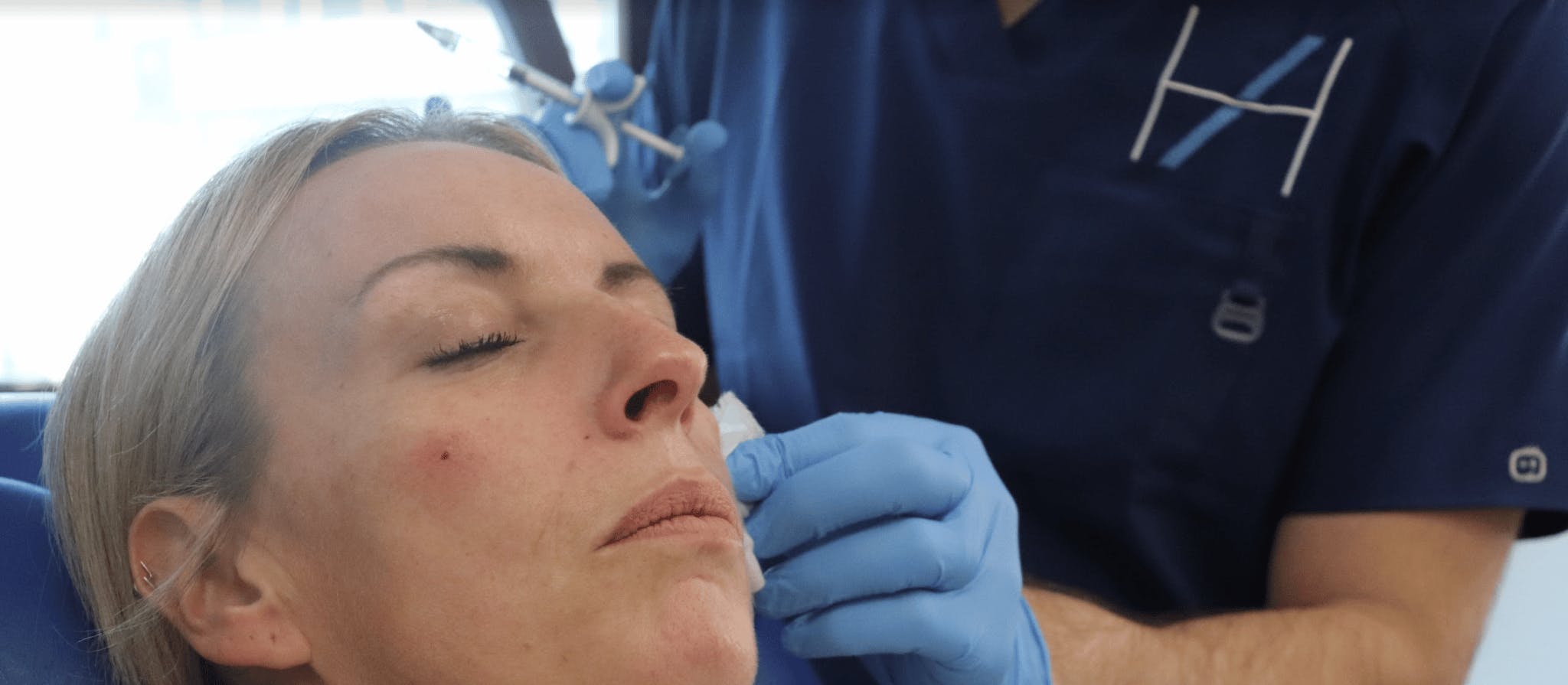 Injecting the piriform fossa nasolabial fold