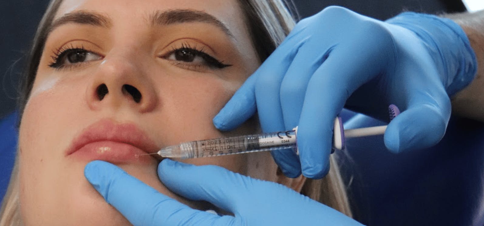 Lip Filler Techniques for New Injectors