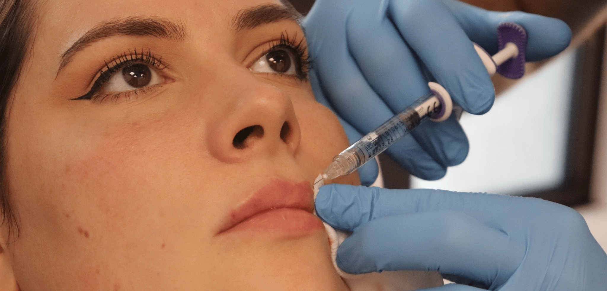 How to inject the Cupid's bow - lip filler injection technique demonstration