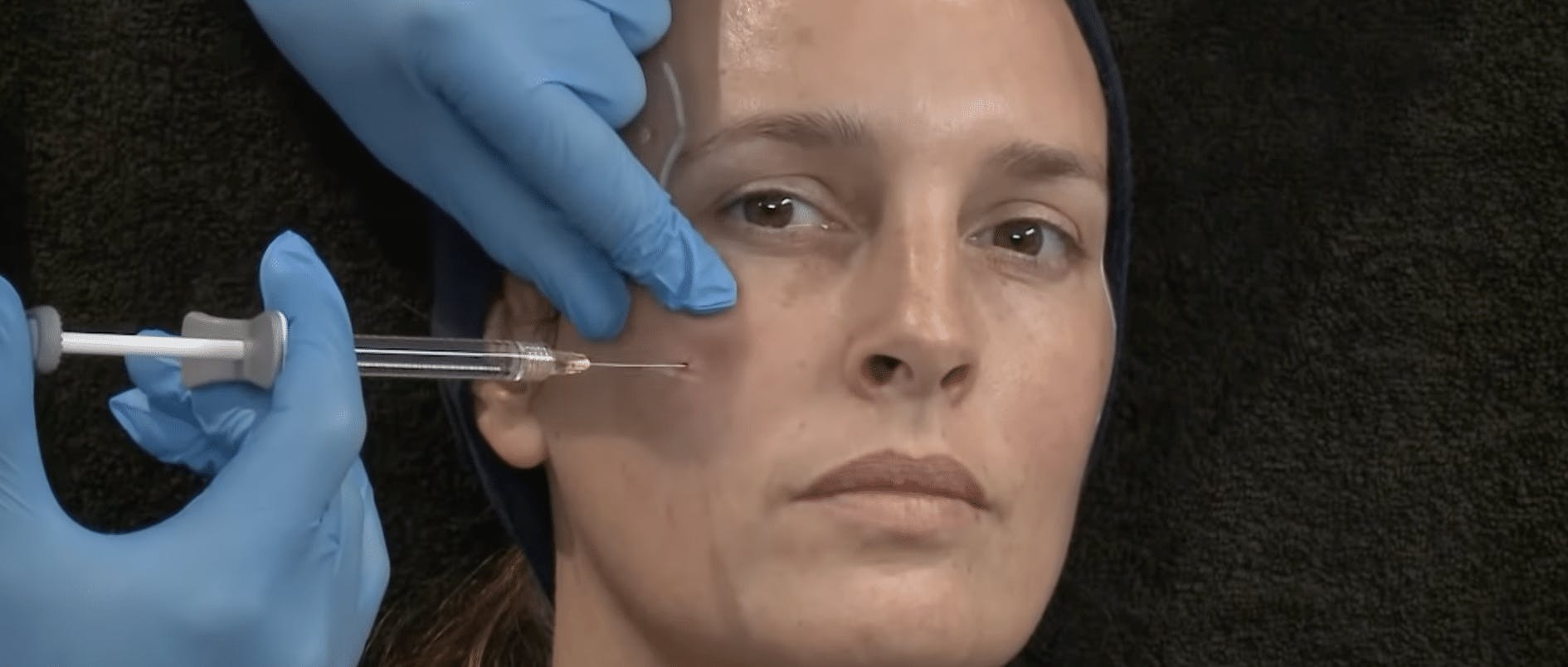 Full Face Dermal Fillers Demonstration