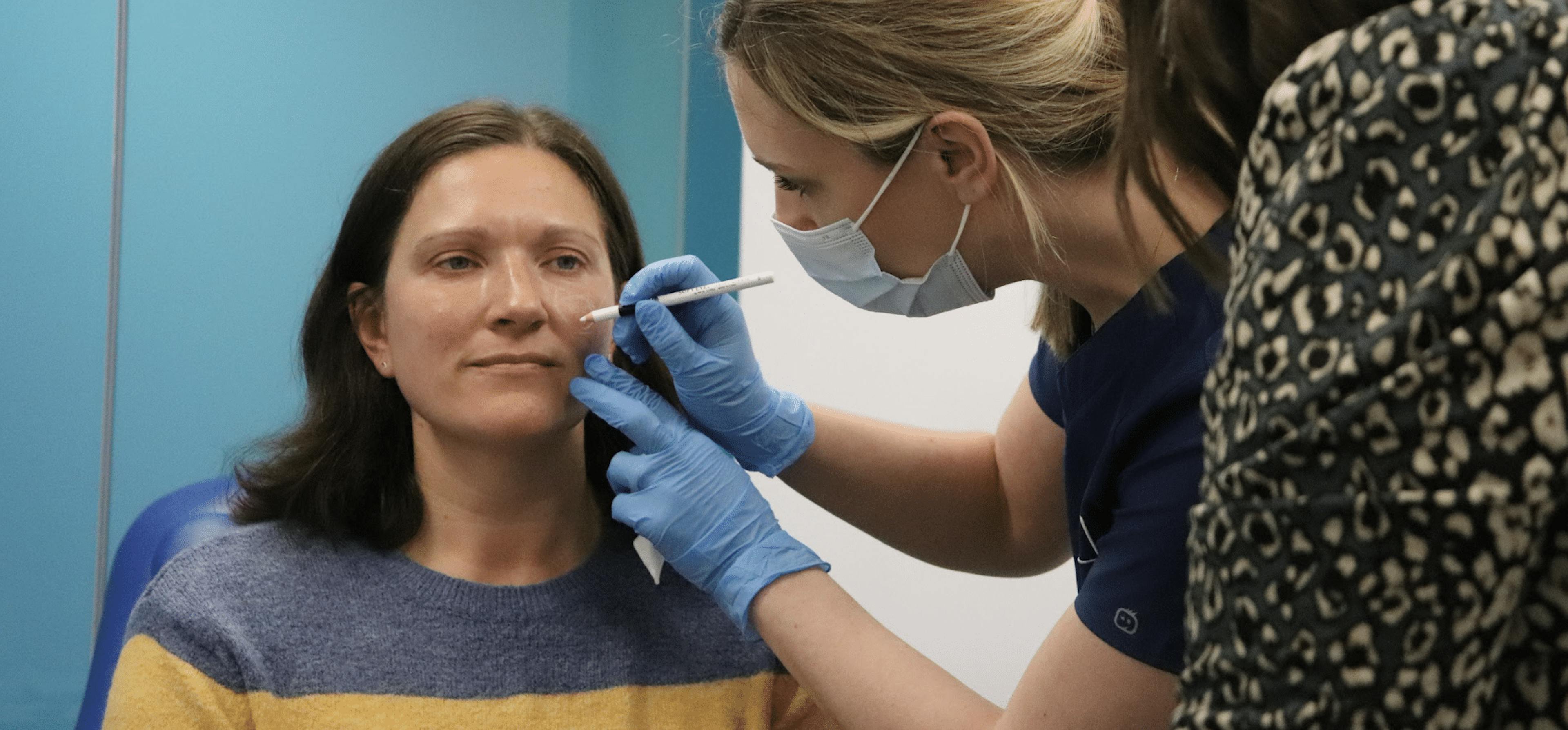 Marking up cheek filler treatment