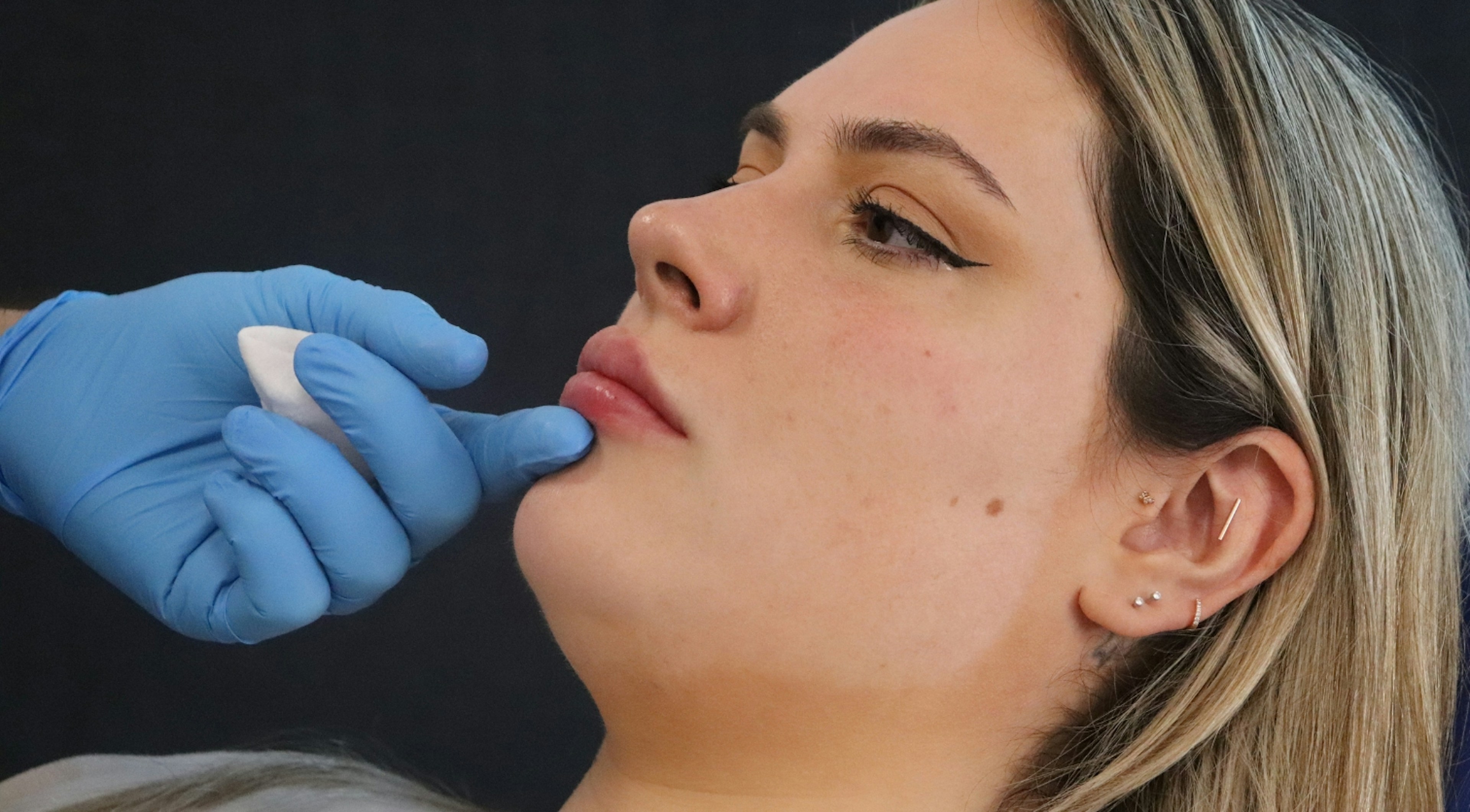 safe even lip filler results training course Harley Academy