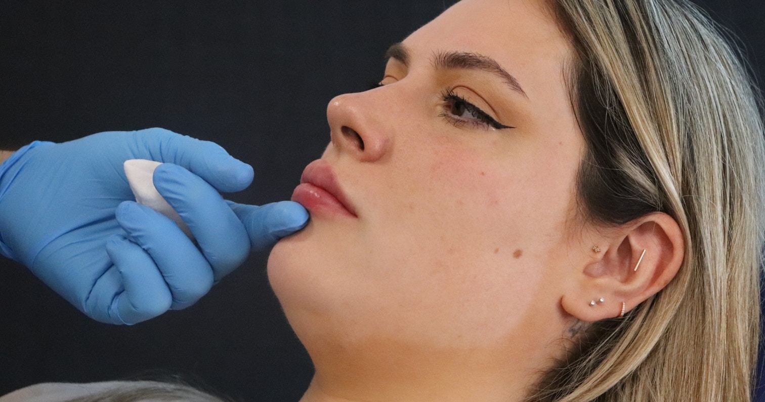safe even lip filler results training course Harley Academy
