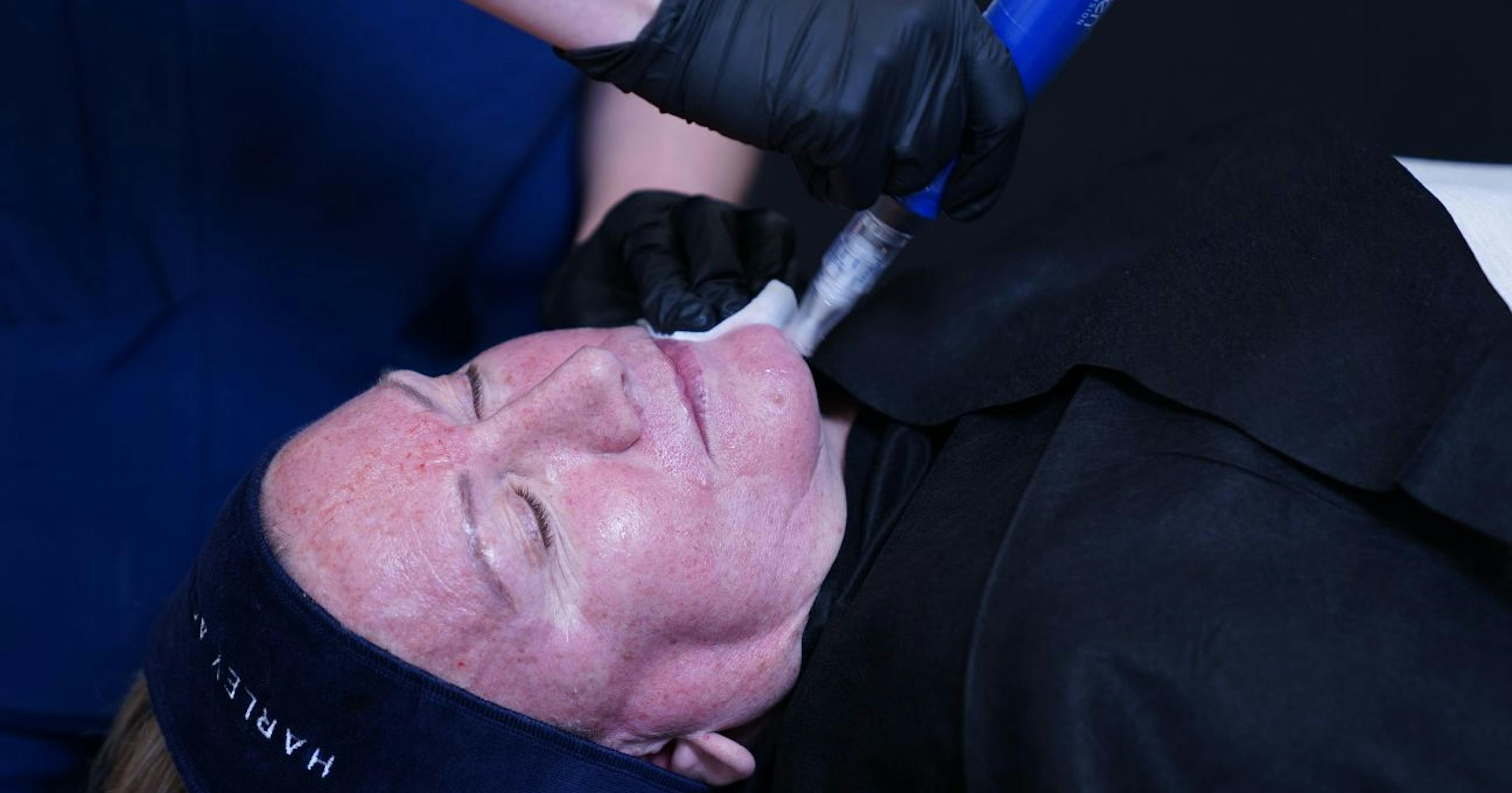 Cosmetic dermatology microneedling course at Harley Academy