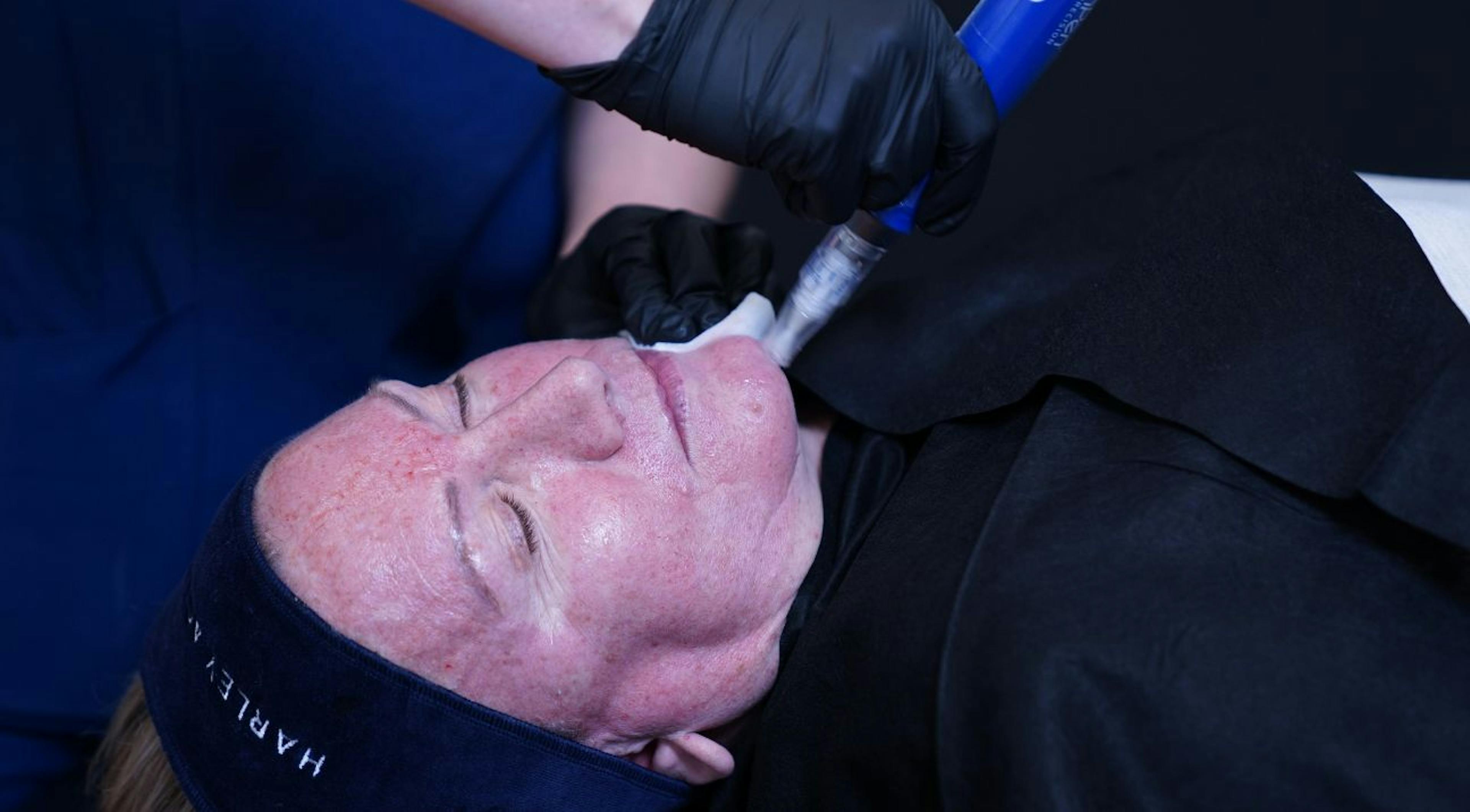 Cosmetic dermatology microneedling course at Harley Academy