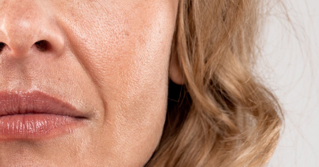 nasolabial fold filler injection techniques