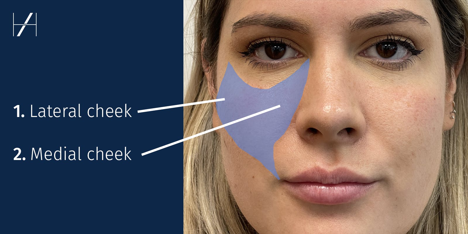 Cheek Filler Injection Techniques Diagram