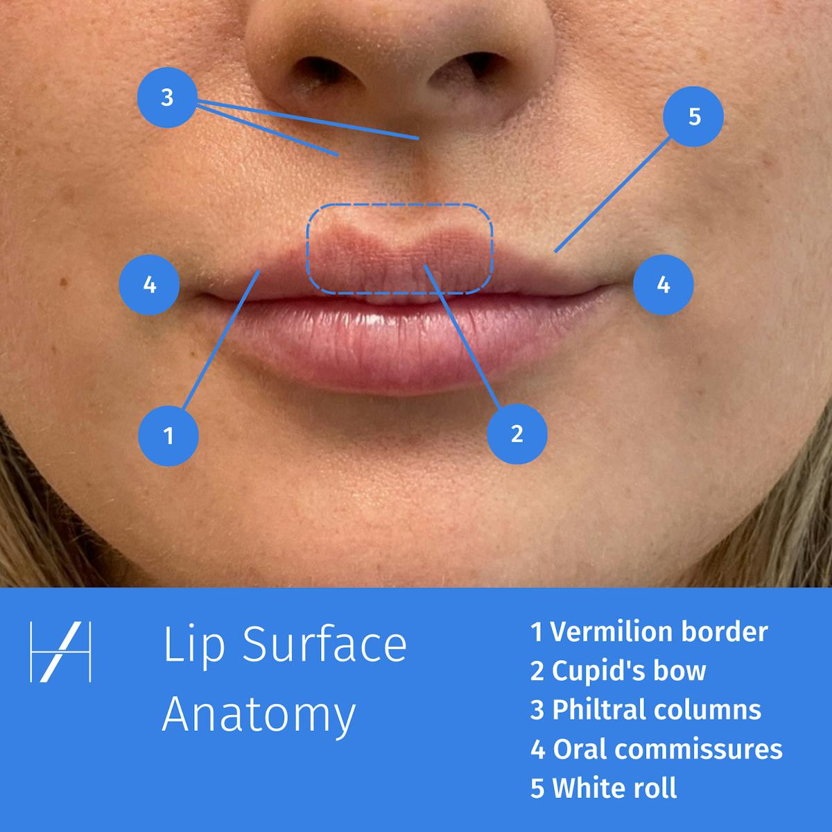 Labiod Lip Anatomy: Surface Guide for Aesthetics Practitioners