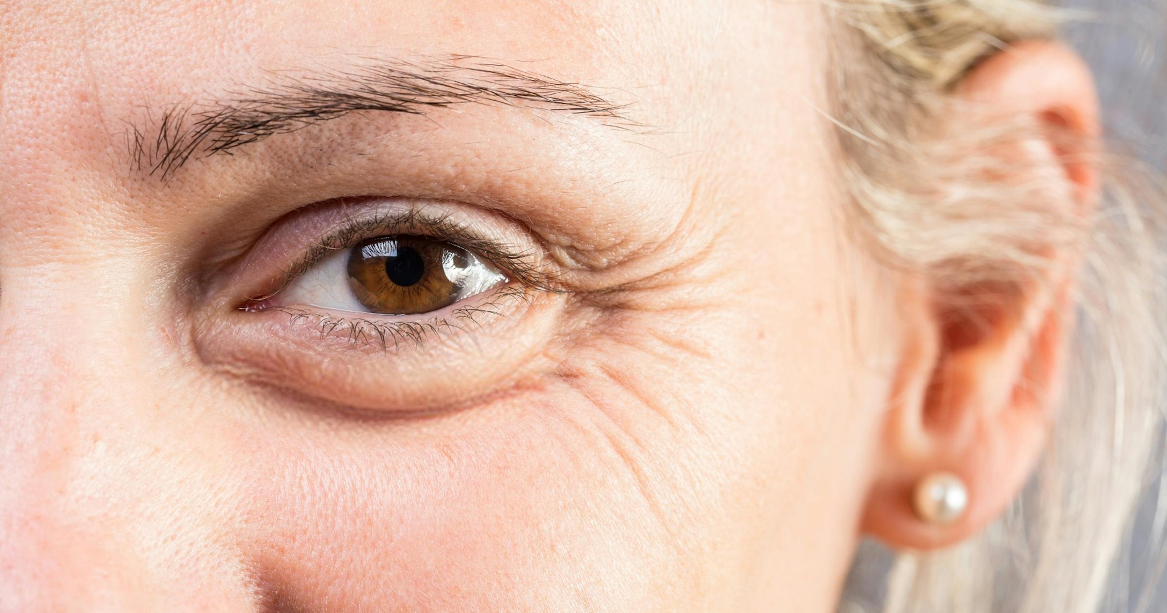 Periorbital Botox: How to Treat Crow's Feet | Harley Academy