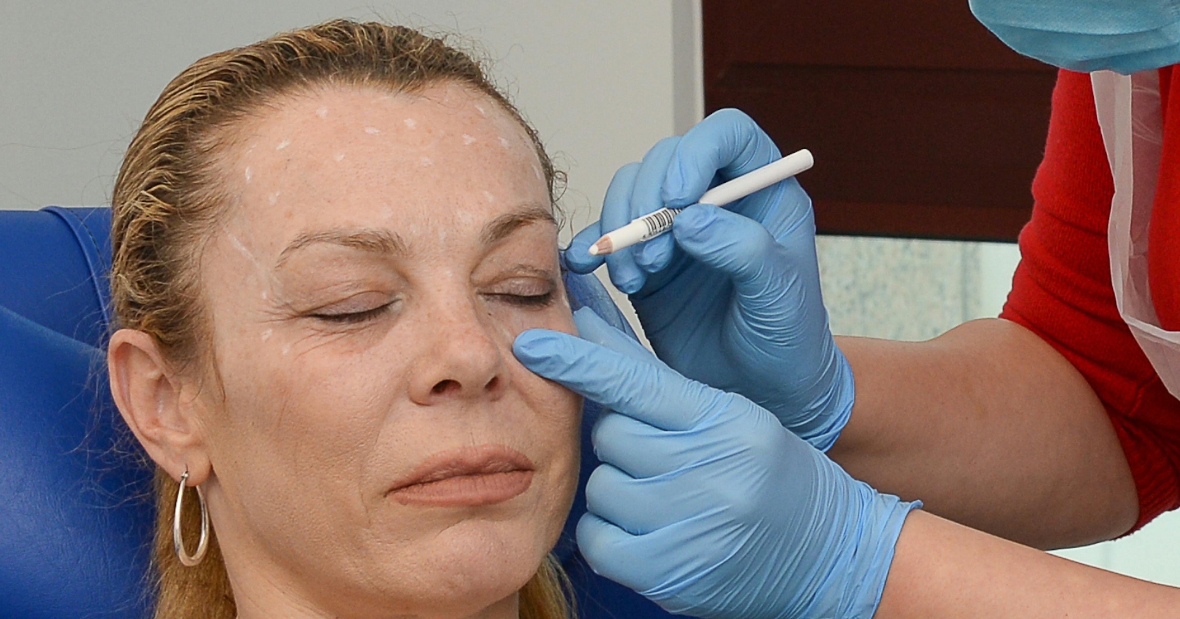 Botox training course - marking up the patient - Harley Academy