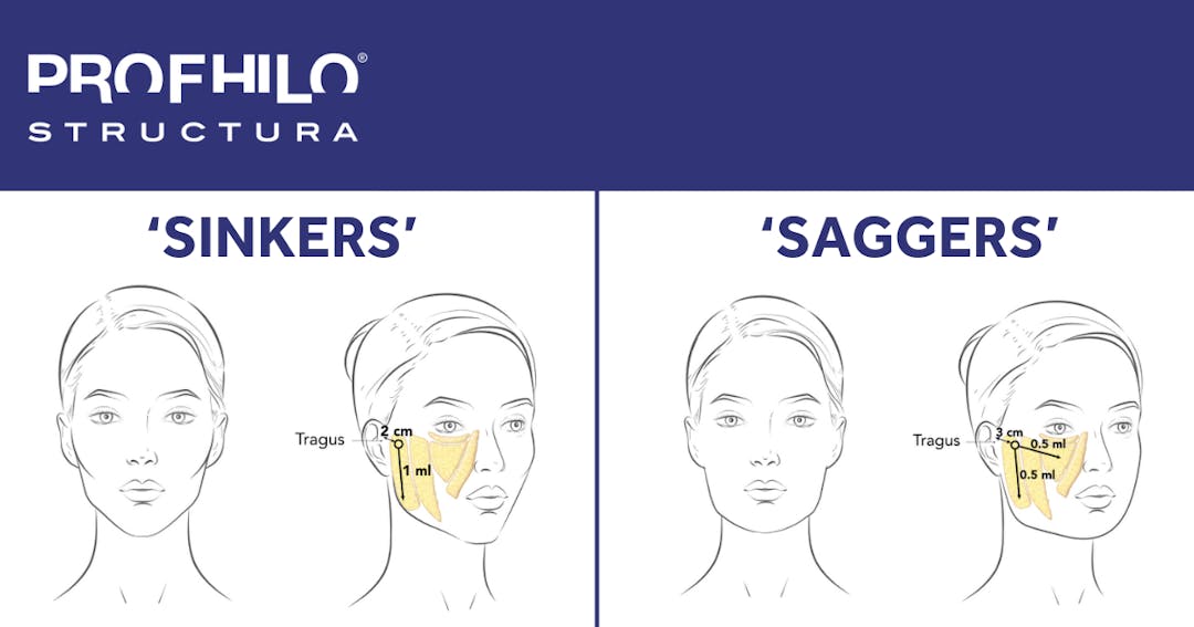 What is Profhilo Structura? New Regenerative Skin Injectable