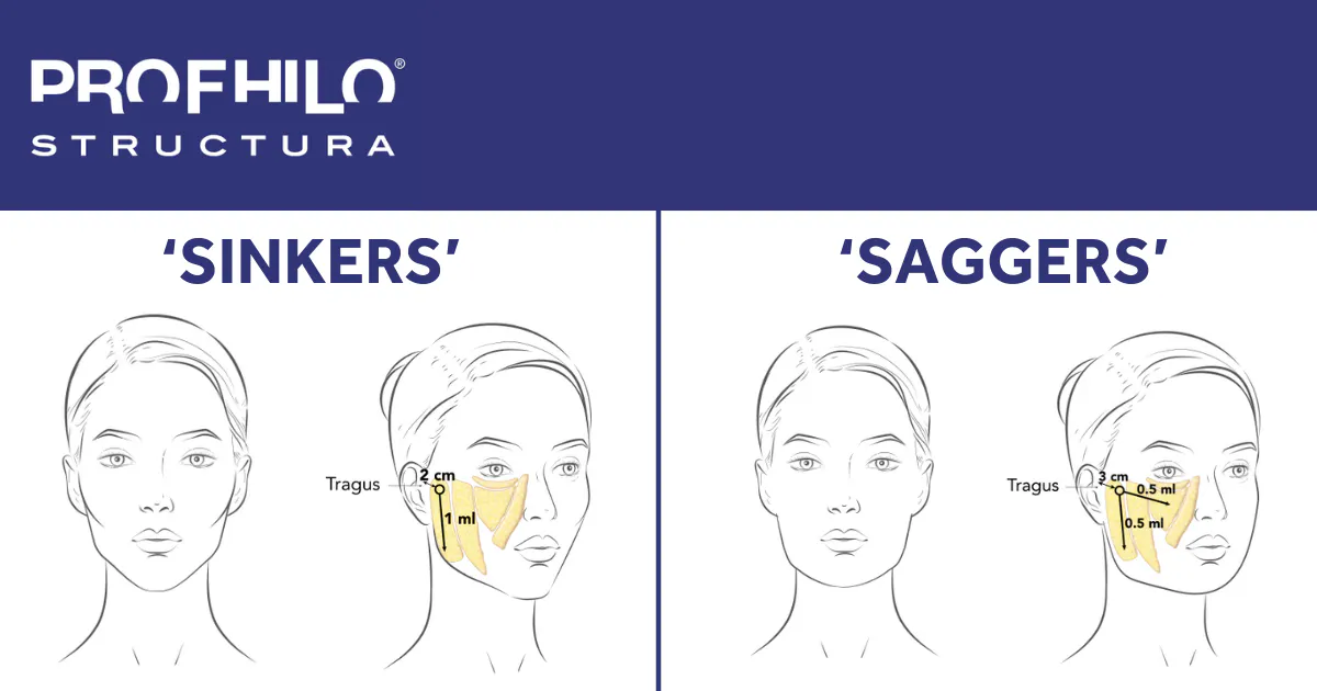 Prophilo Remote What is Profhilo Structura? New Regenerative Skin Injectable