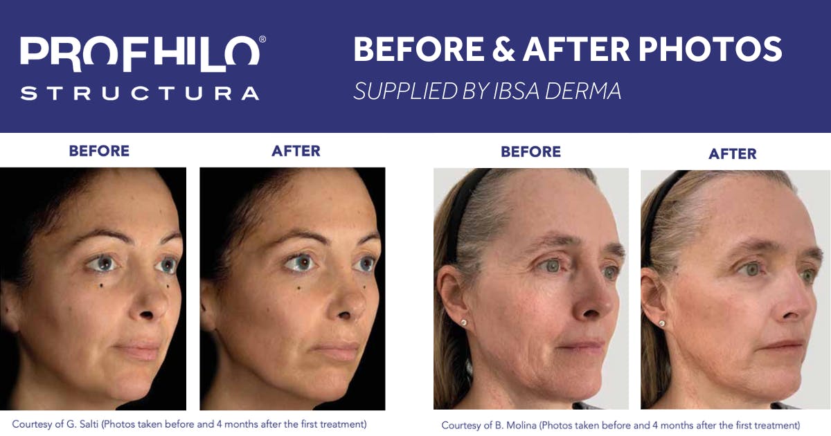 Profhilo Structura Before and After photos