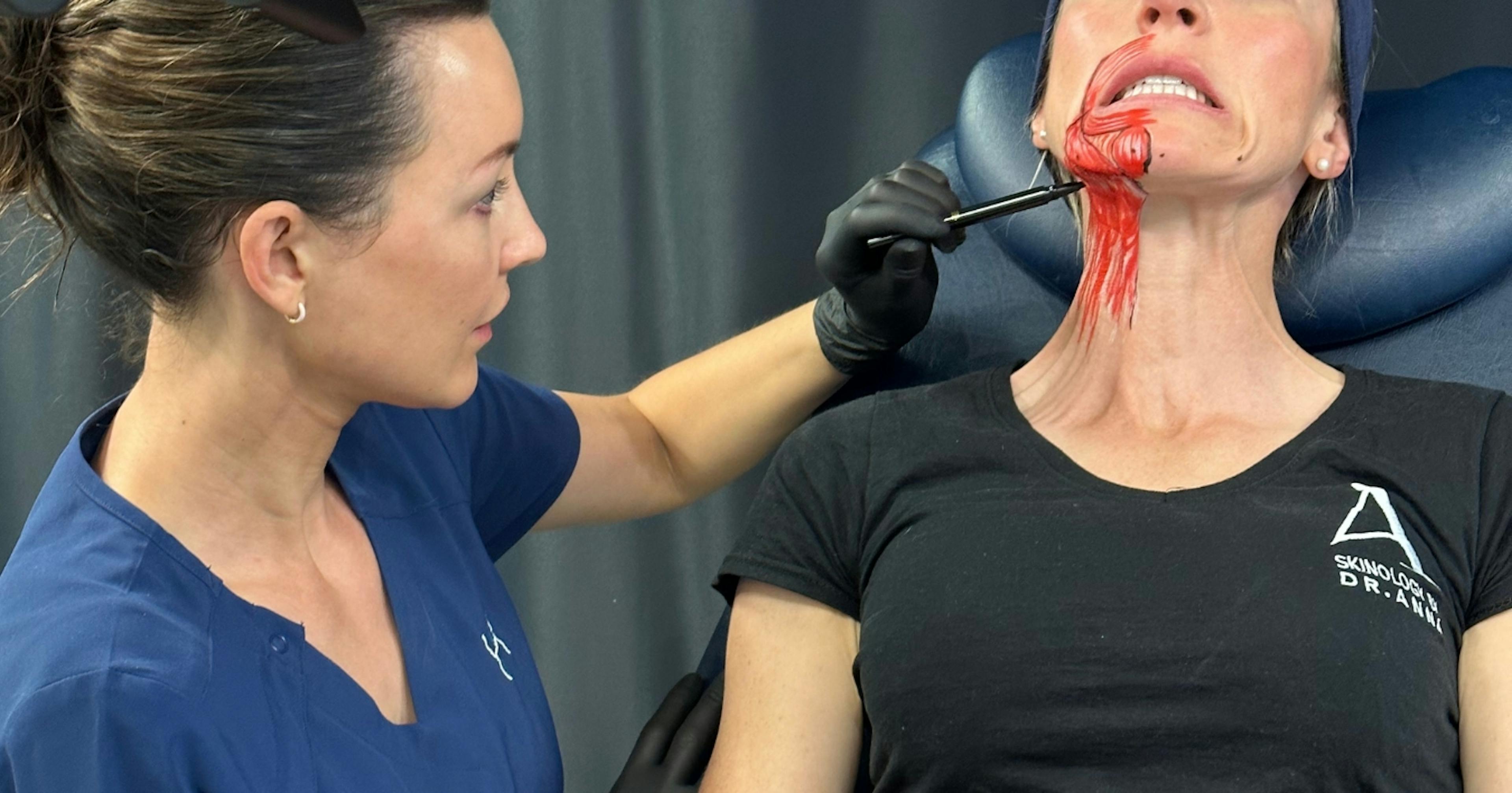 How to treat platysmal bands - vertical neck lines