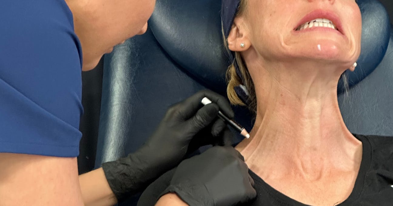 Marking up for platysmal bands botox advanced treatment course