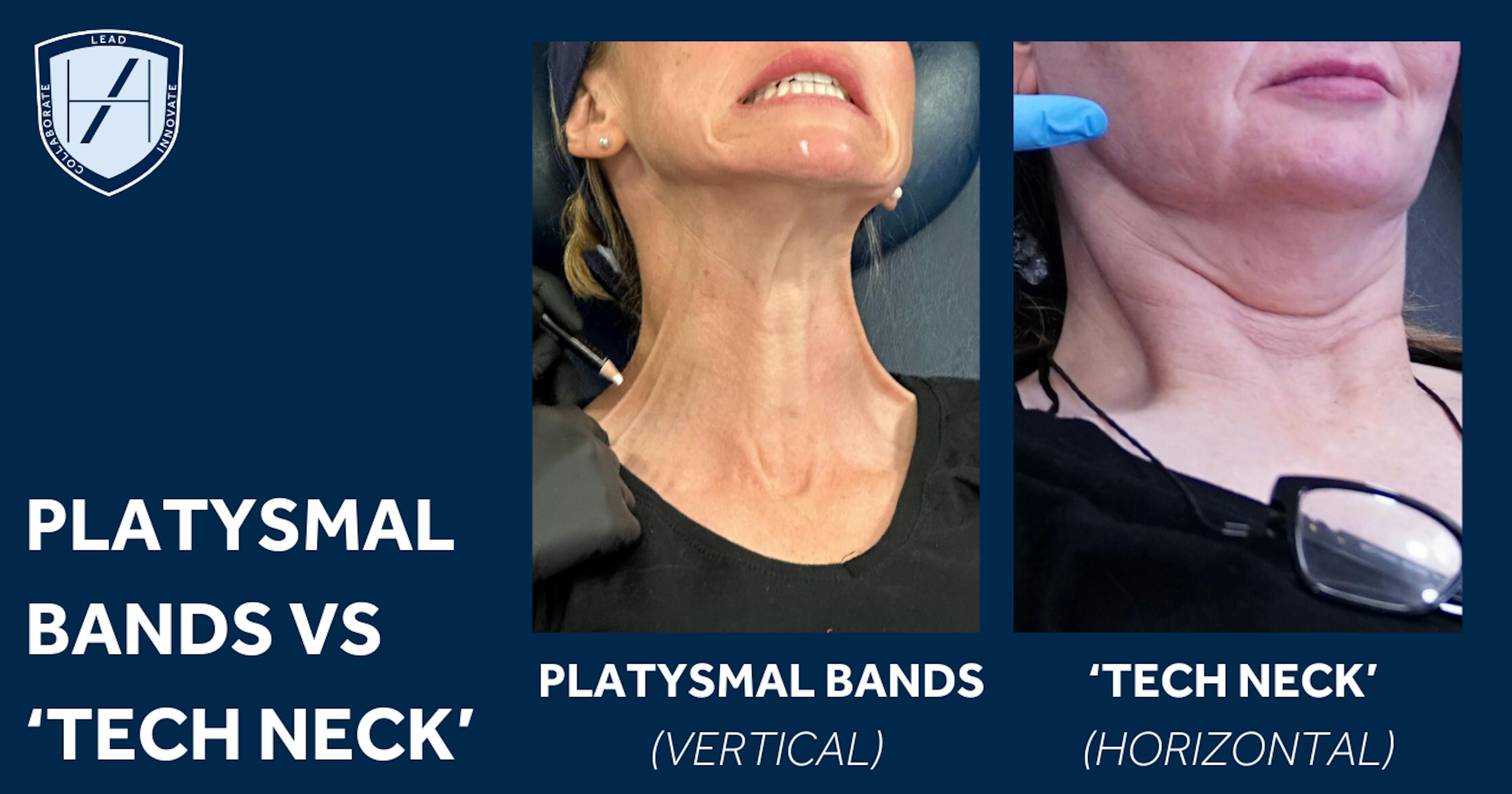 Diagram - What's the difference between Platysmal bands and Tech Neck