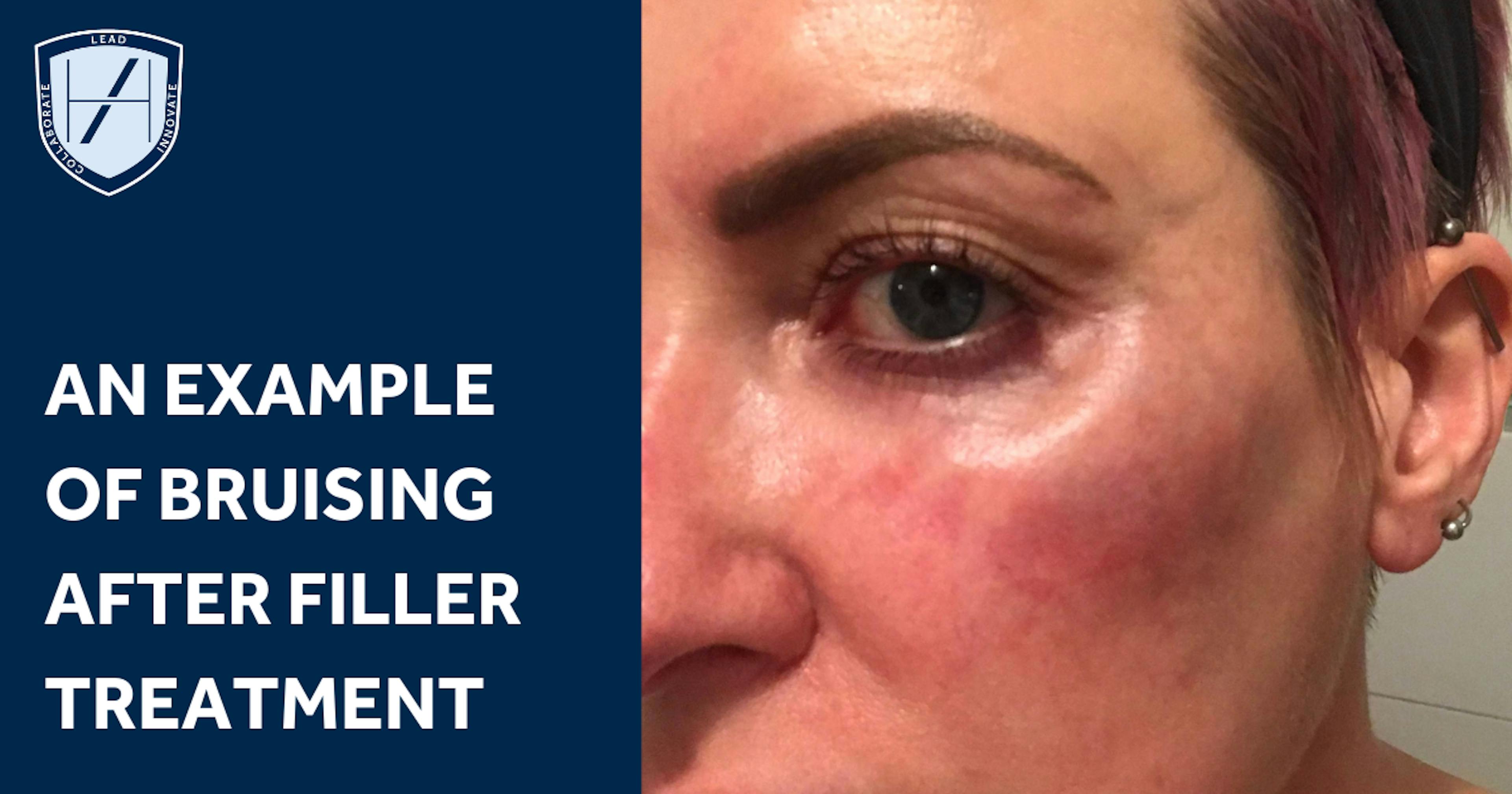 Complications example of bruising after filler injections