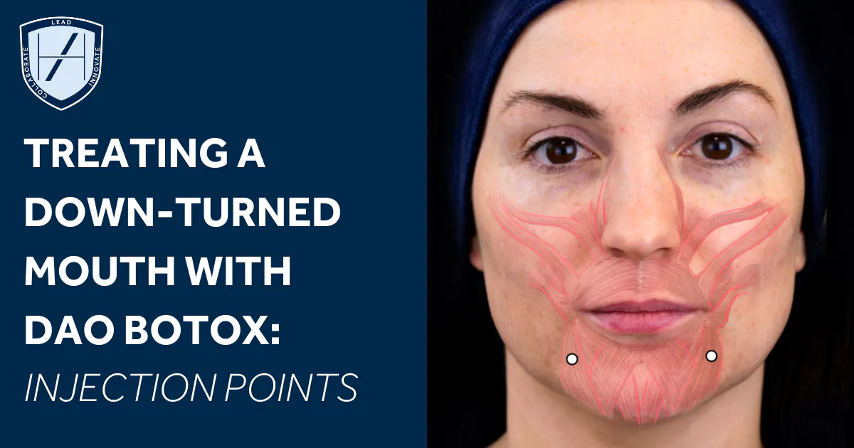 Treating a Down-Turned Mouth with Botox | Harley Academy