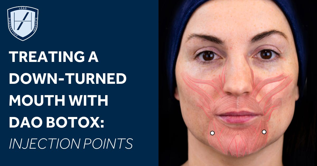 Harley Academy DAO botox injection points diagram