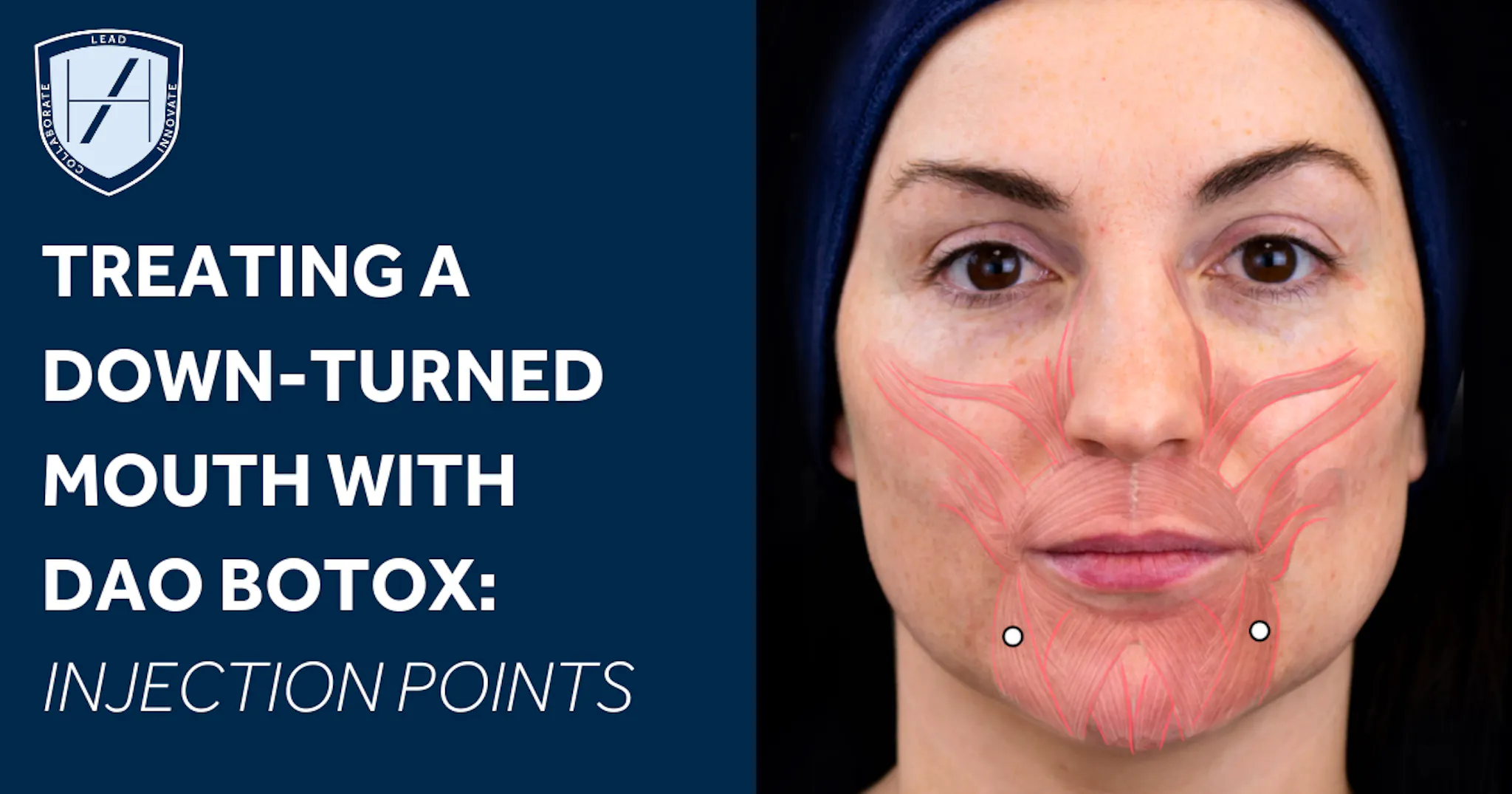 Treating a Down-Turned Mouth with Botox | Harley Academy
