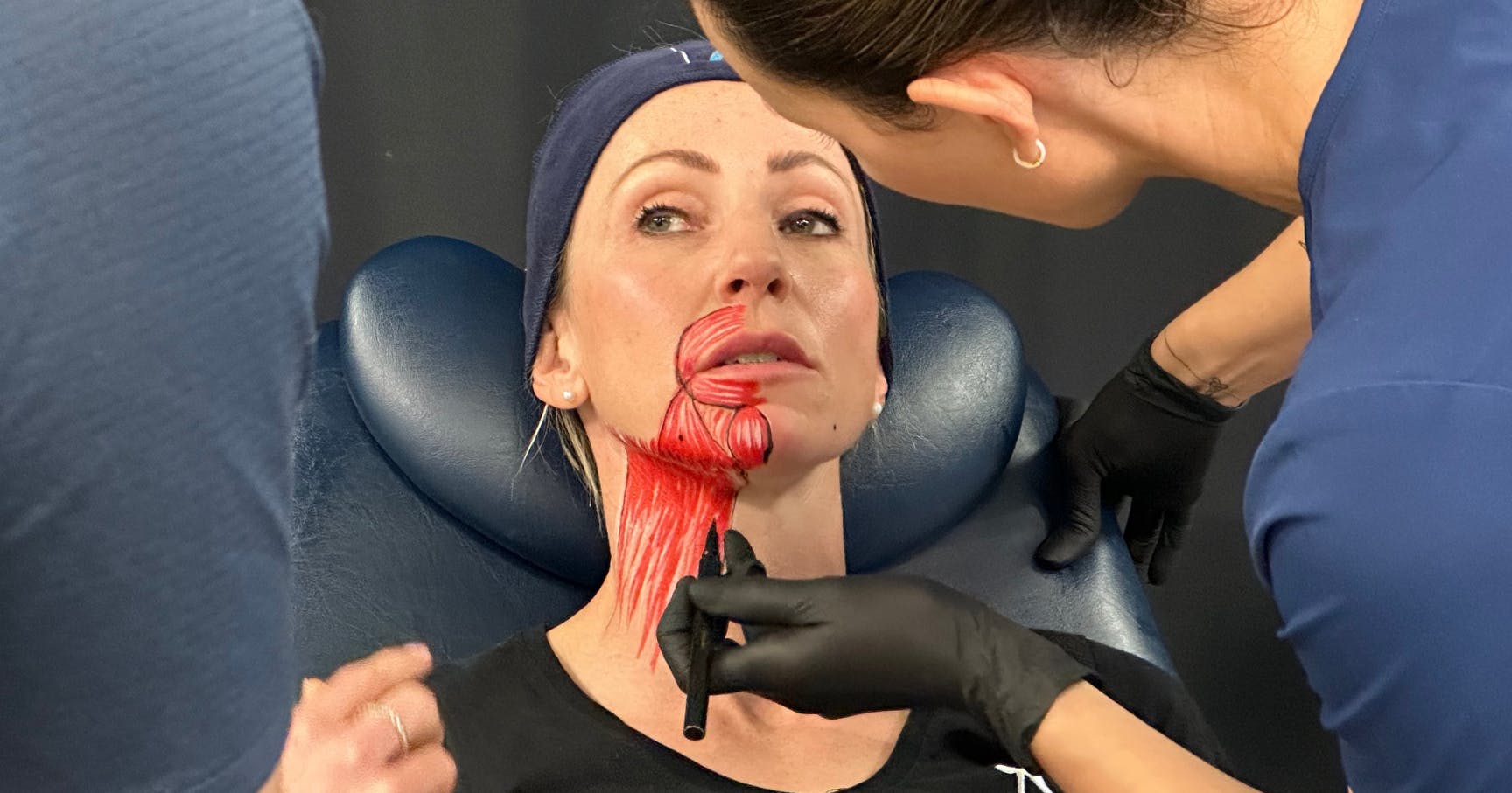 DAO botox - how to treat a down-turned mouth