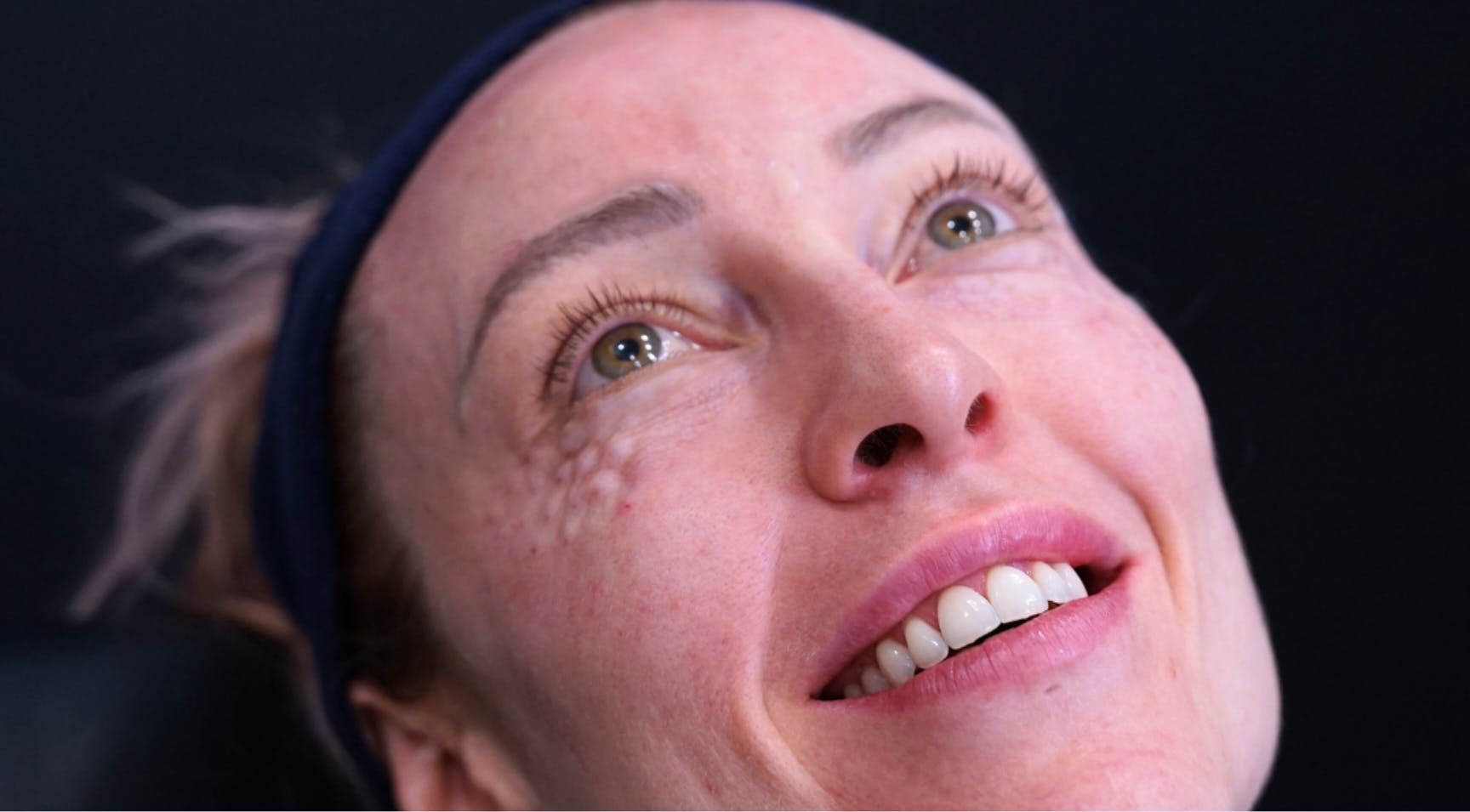 Polynucleotides training course under eye treatment demonstration at Harley Academy