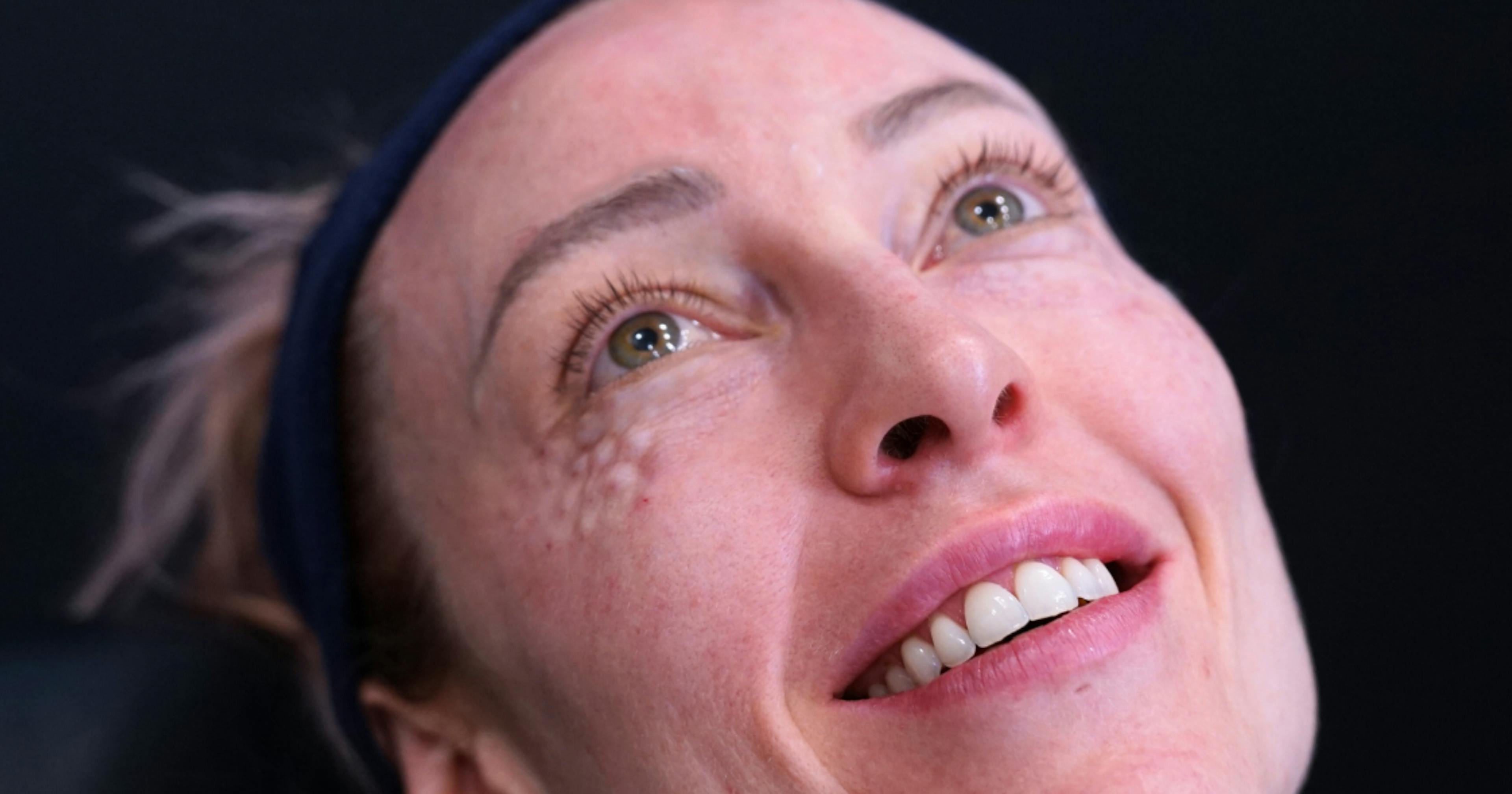 Polynucleotides training course under eye treatment demonstration at Harley Academy