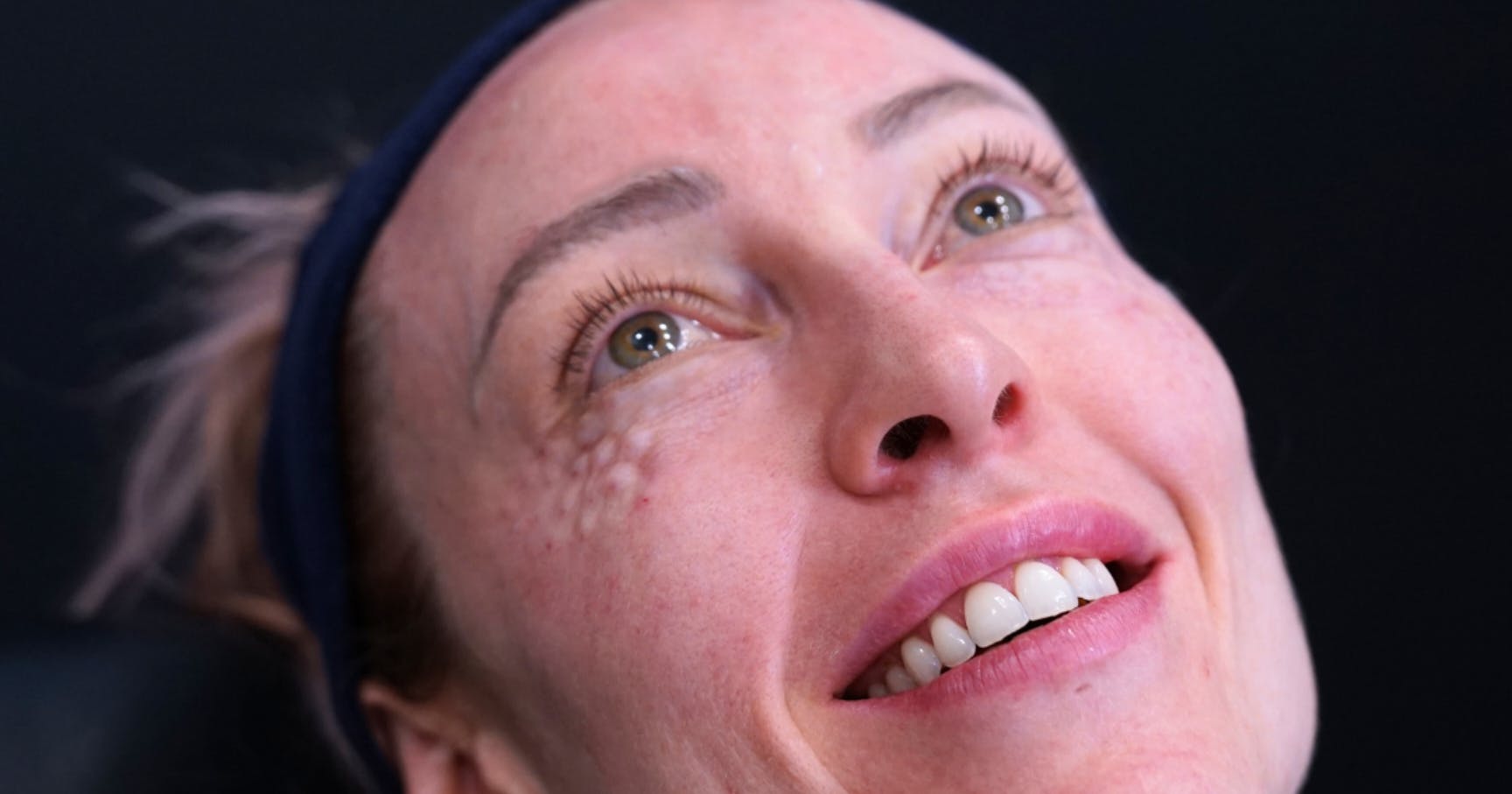 Polynucleotides training course under eye treatment demonstration at Harley Academy