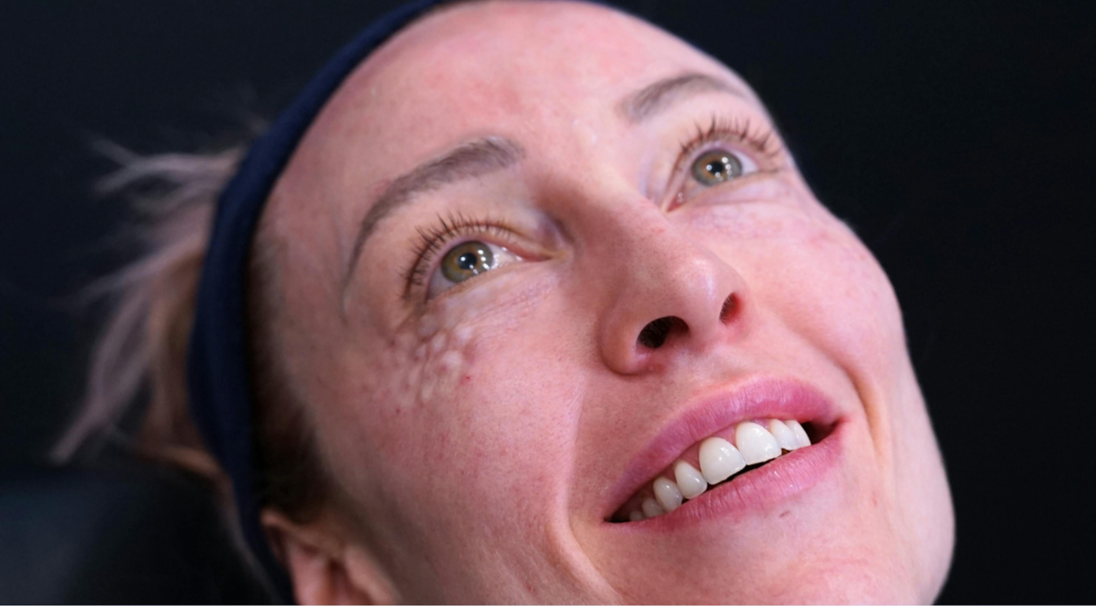 Polynucleotides training course under eye treatment demonstration at Harley Academy