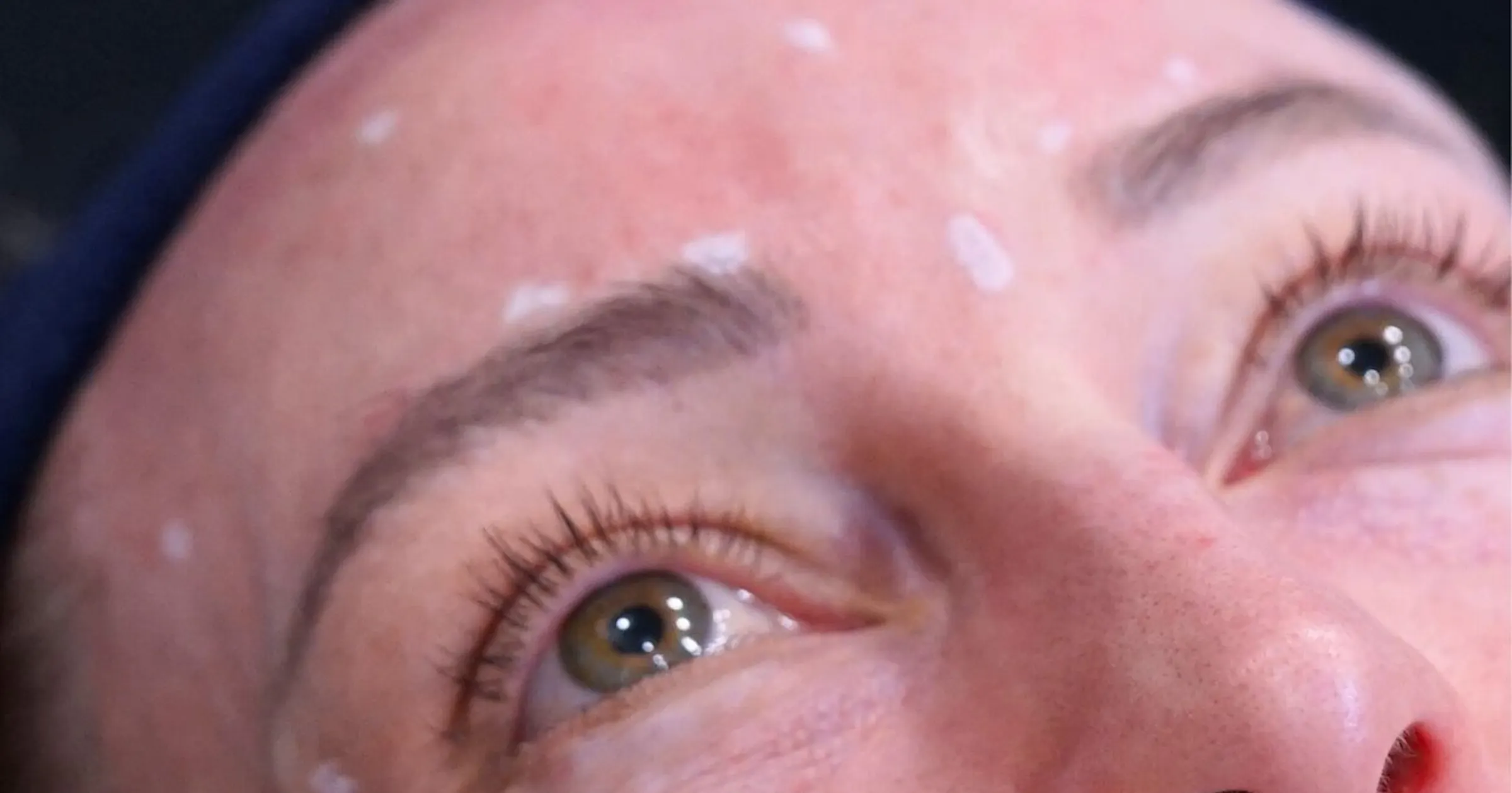How to Manage Common Botox Complications in Aesthetics | Harley Academy