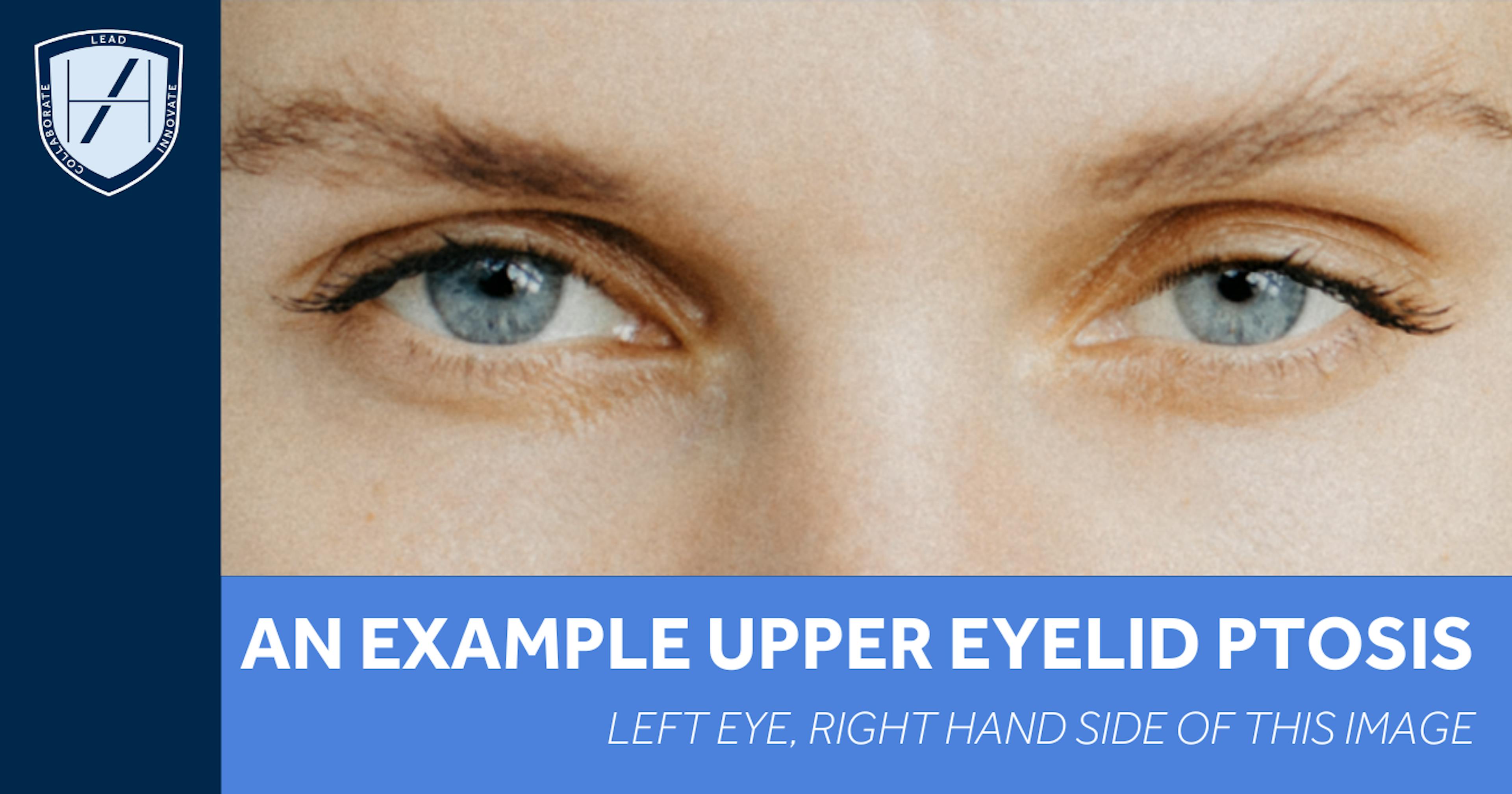 Diagram: Example of Upper Eyelid Ptosis Following Botox