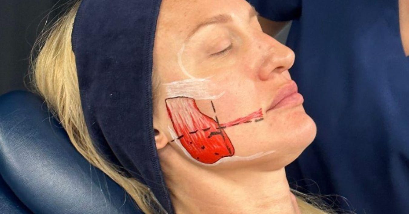 Masseter muscle diagram during advanced botox training at Harley Academy