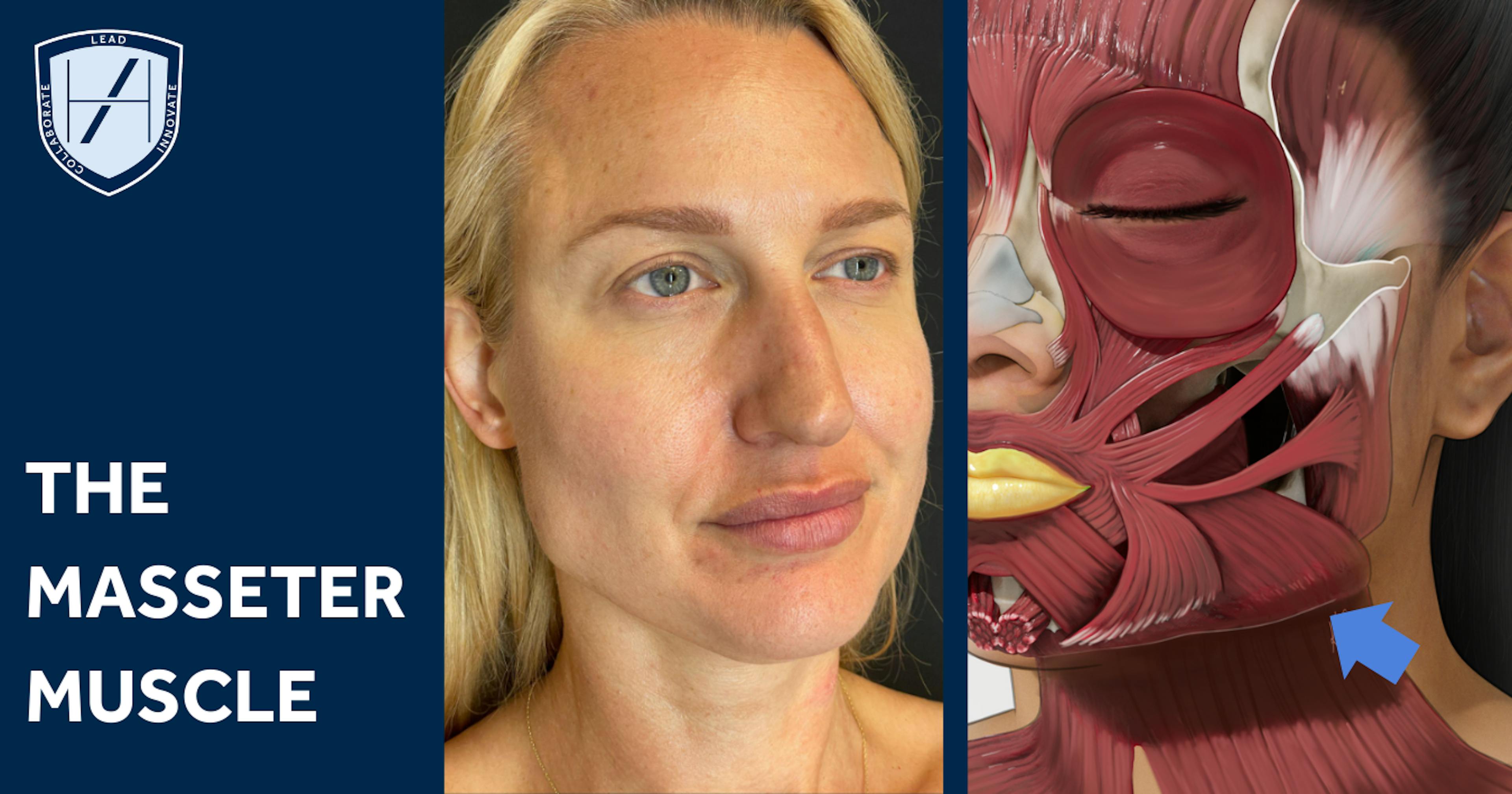 Masseter muscle diagram - Advanced Botox