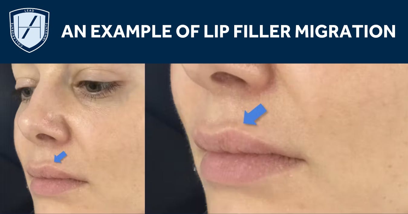 Lip Filler Migration Diagram