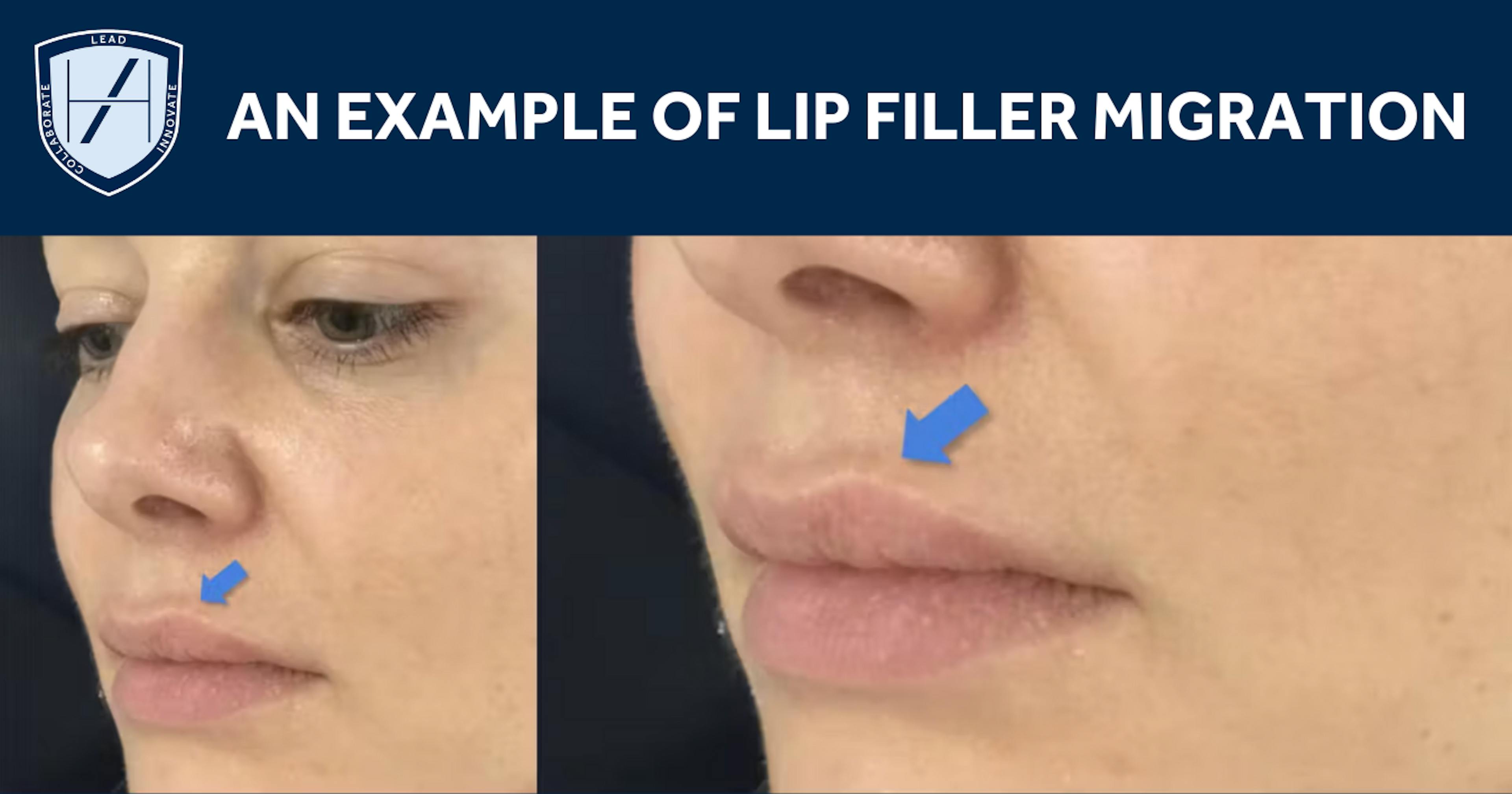 Lip Filler Migration Diagram