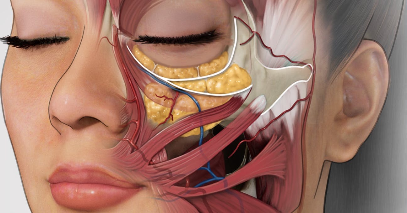 Treating the SOOF - Sub-orbicularis oculi fat