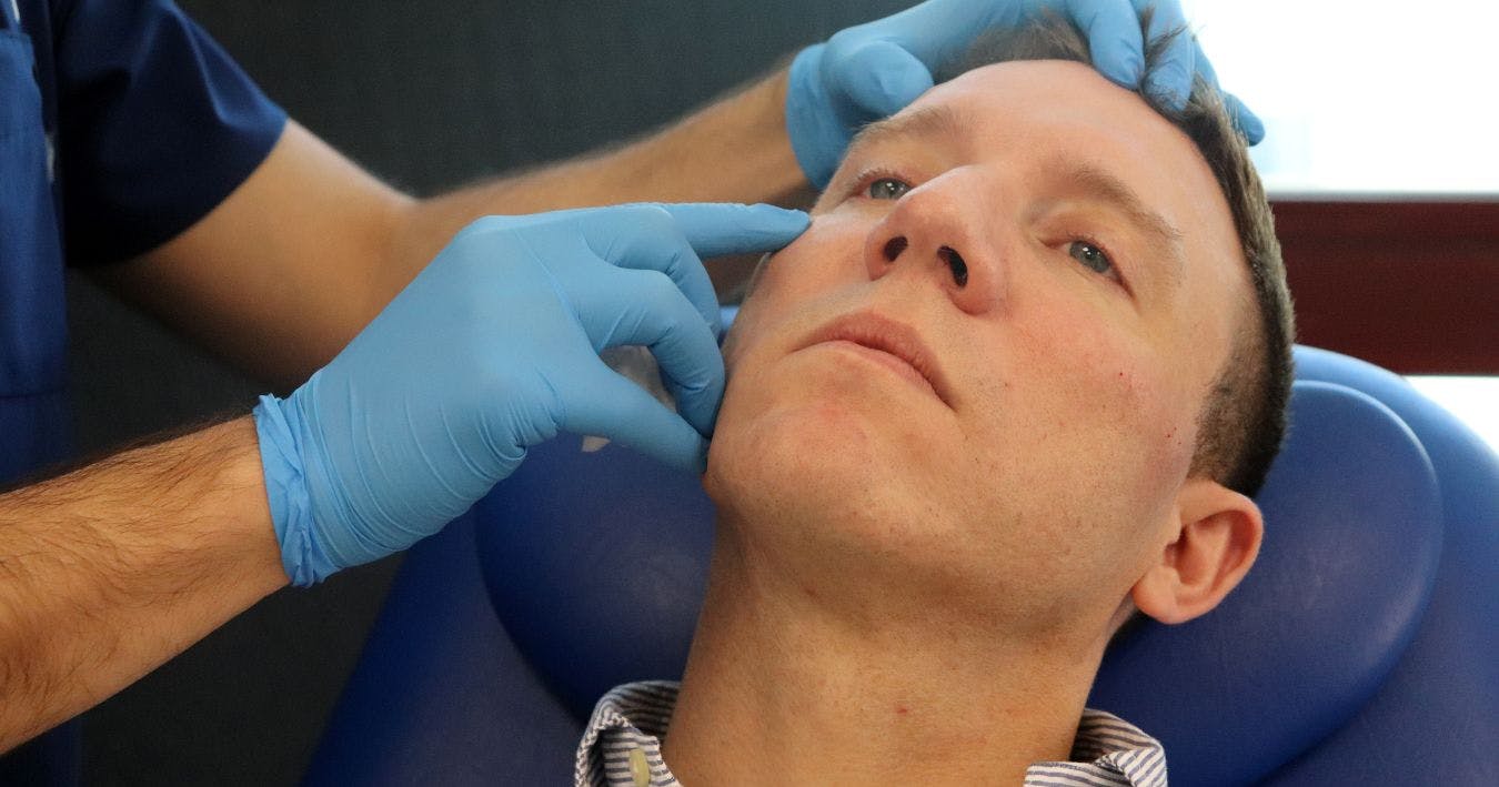 Cheek filler - treating the male patient