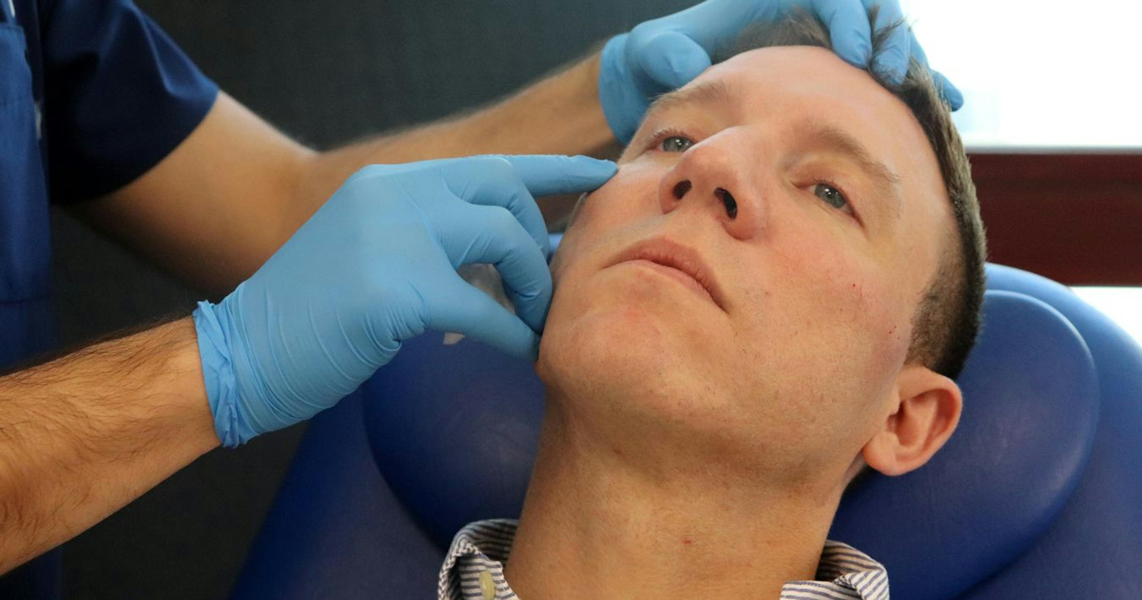 Cheek filler - treating the male patient