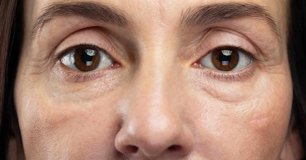 Tear trough filler versus polynucleotides for under eye concerns