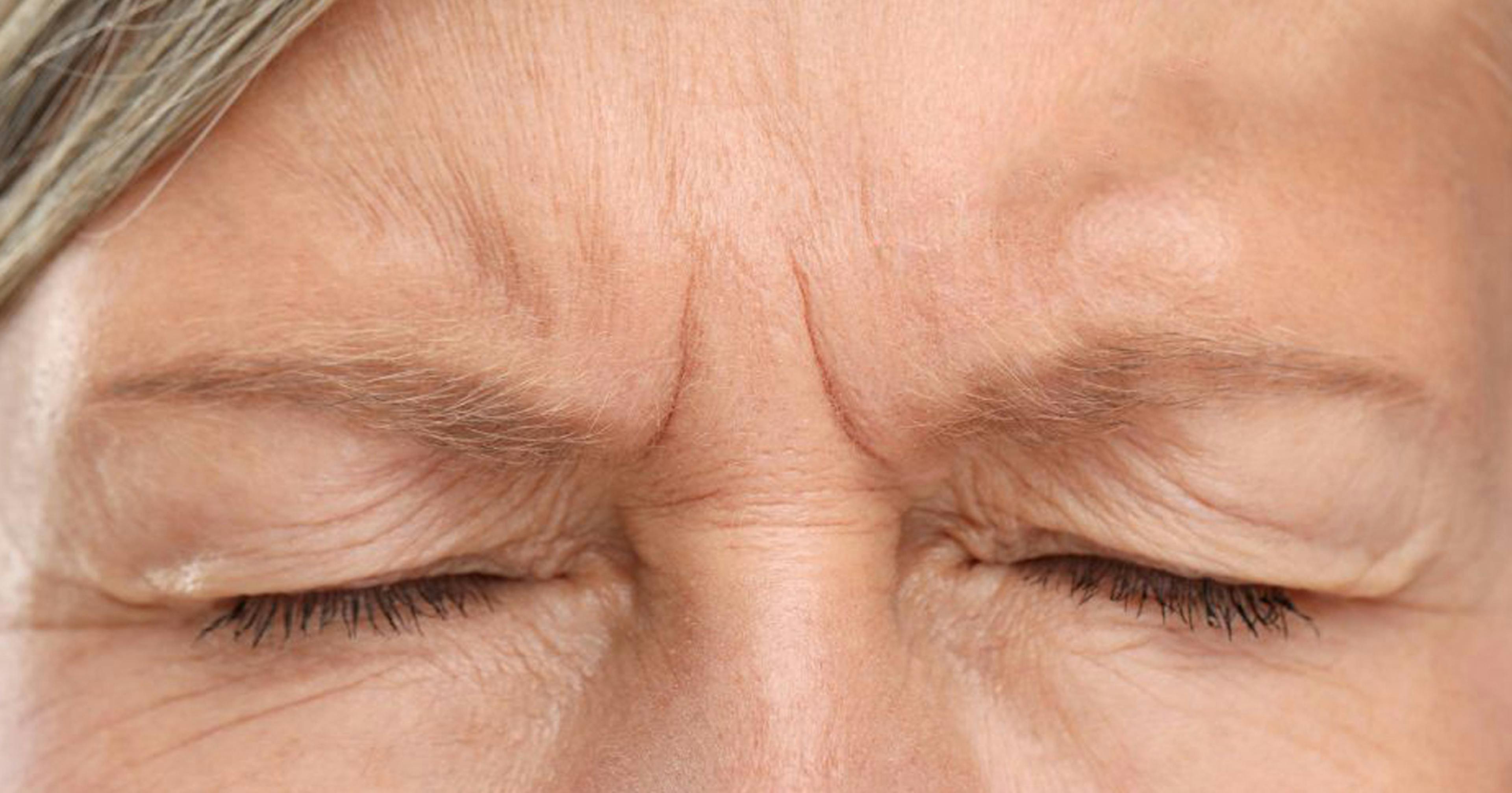 Preventing blindness from fillers - Glabellar treatment