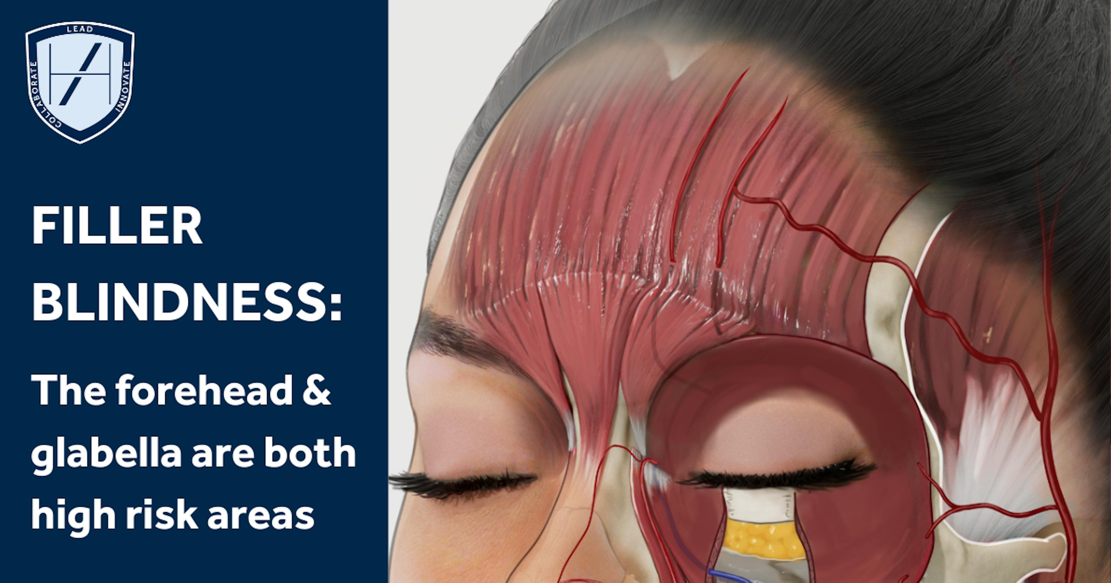 The forehead and glabella are high risk treatment areas for filler blindness