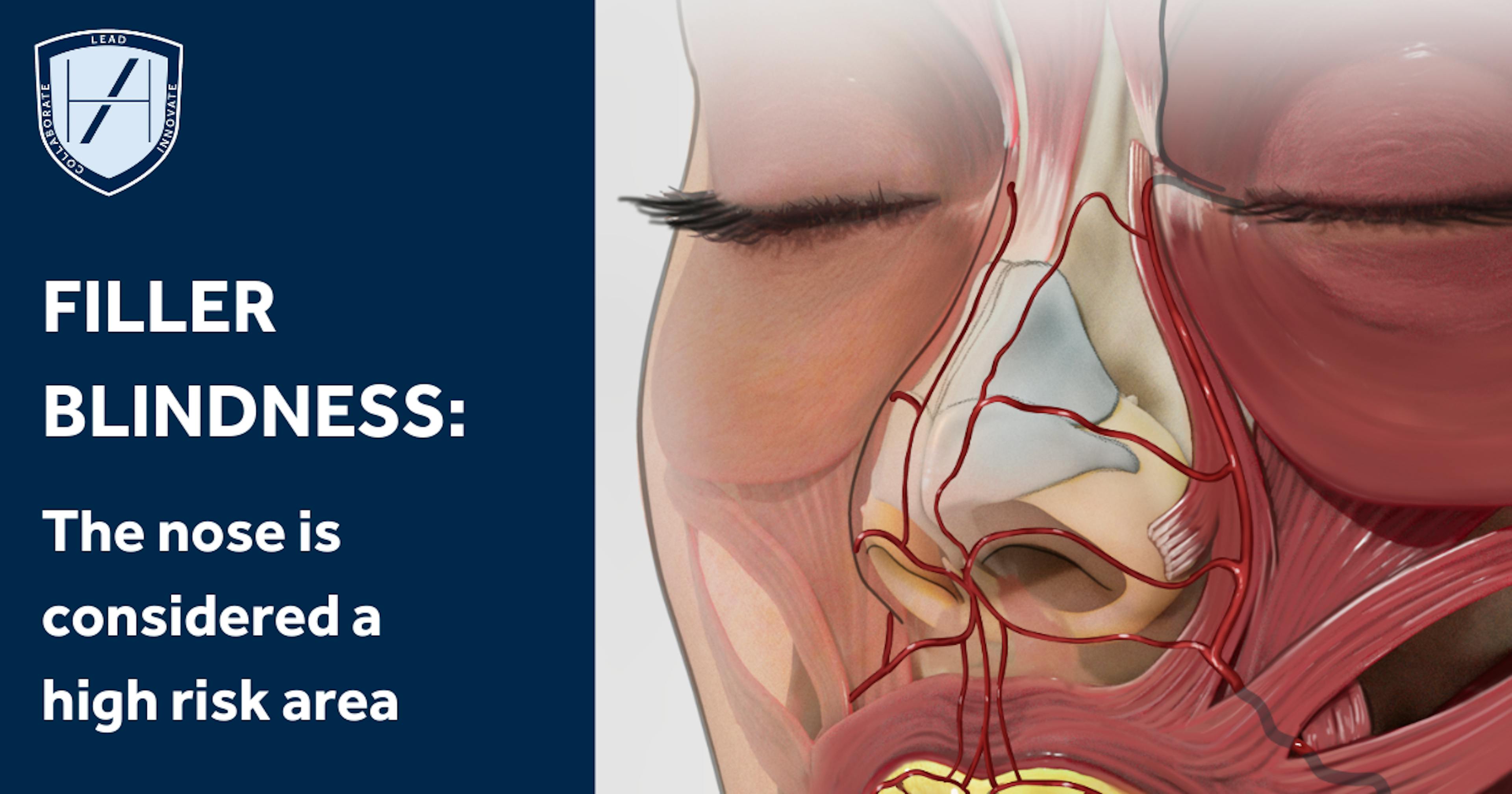 Diagram - non-surgical rhinoplasty - nose filler - is a high risk treatment for filler blindness