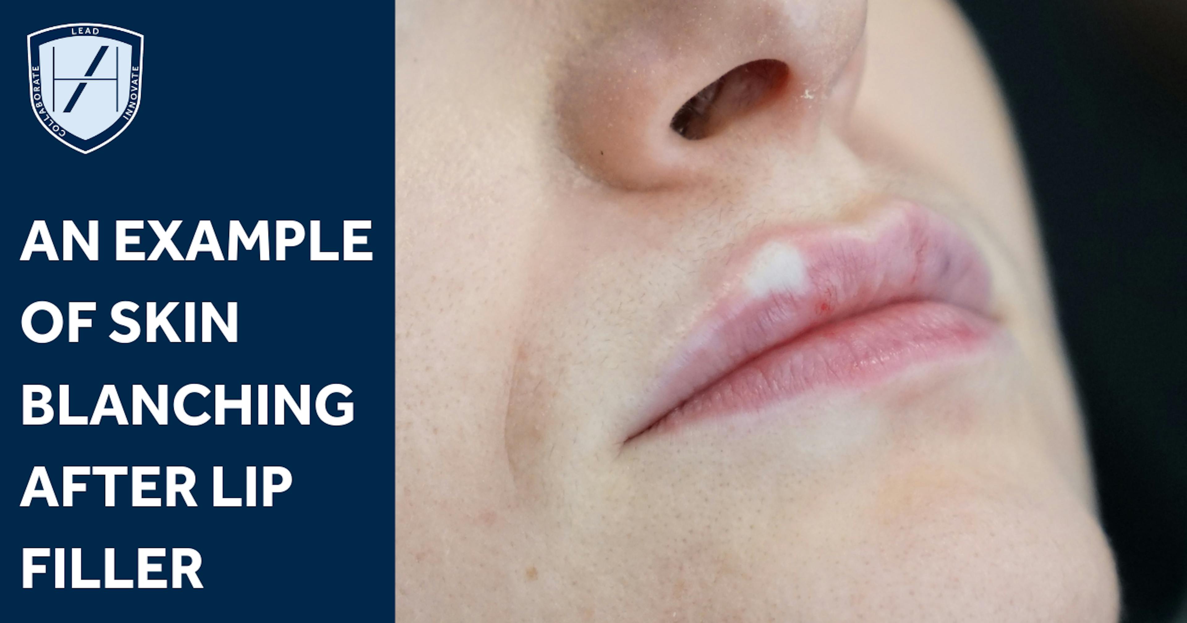 Skin blanching after lip filler injections - Harley Academy diagram