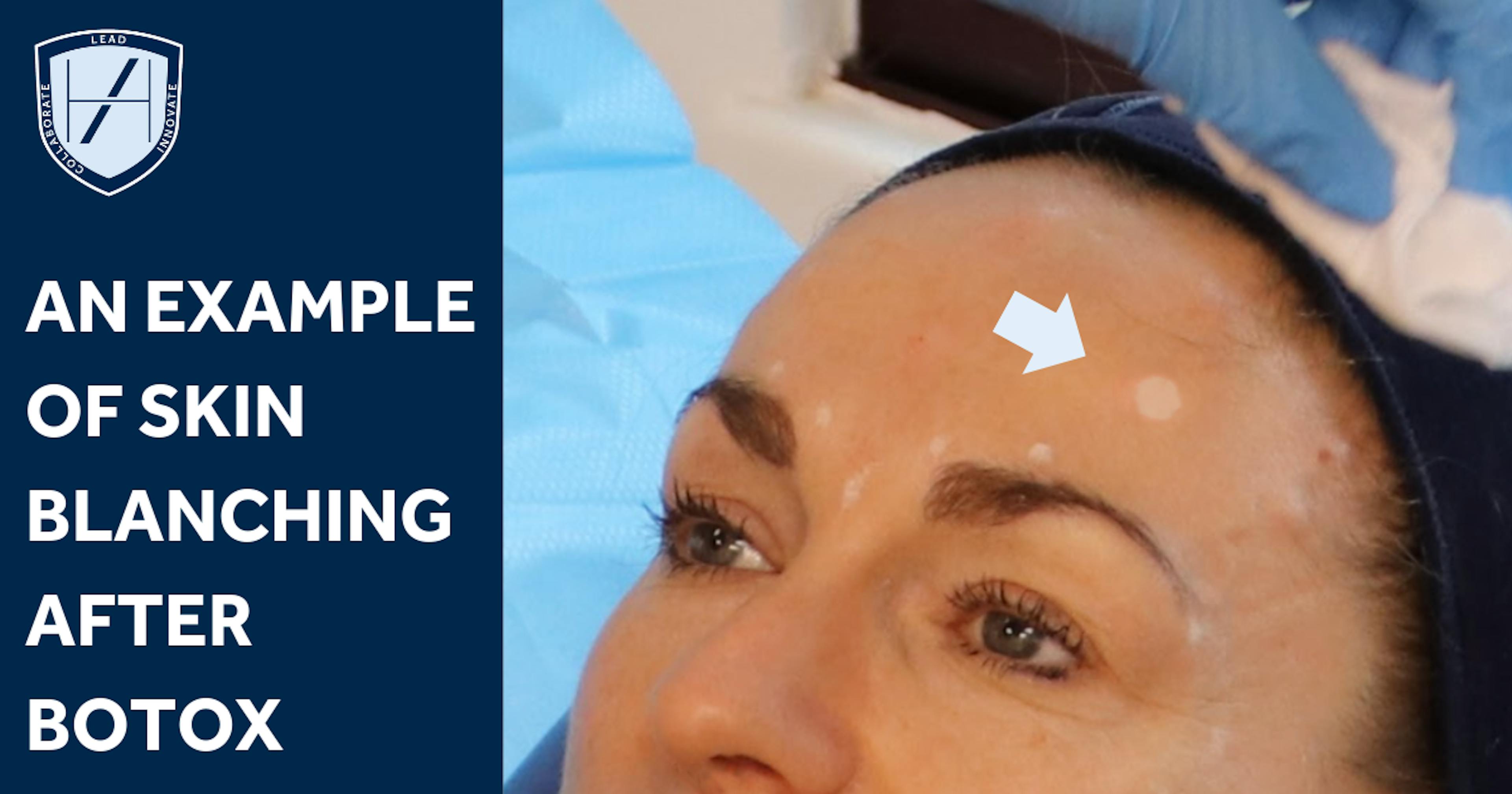 Example of blanching after botox - Harley Academy advice for aesthetics practitioners