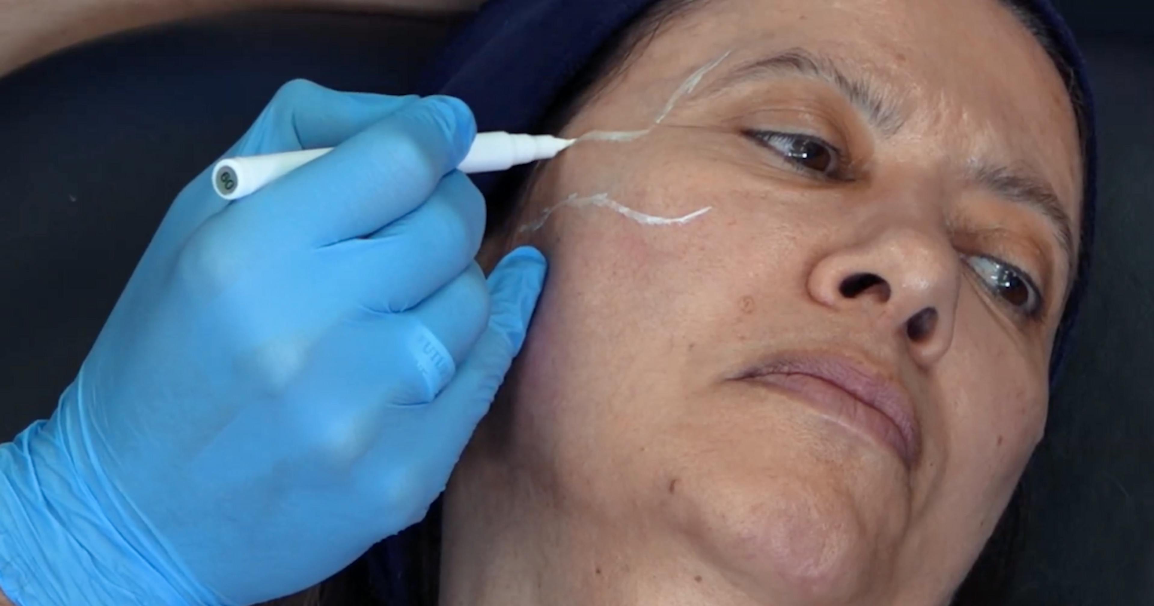 How to mark up for lateral zygoma cheek filler