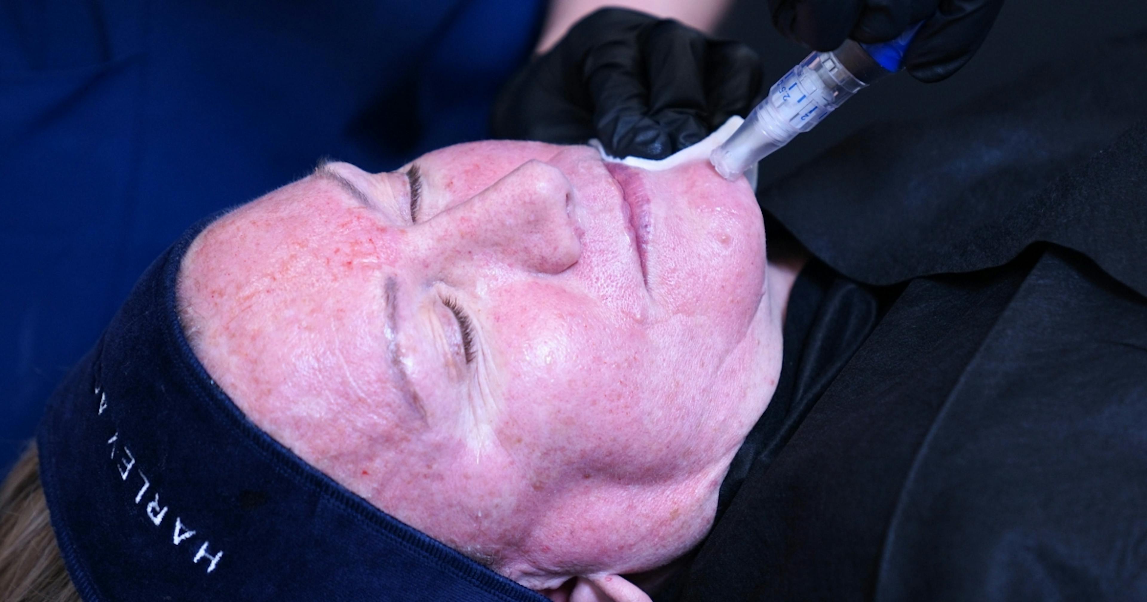 Chin microneedling to improve skin quality