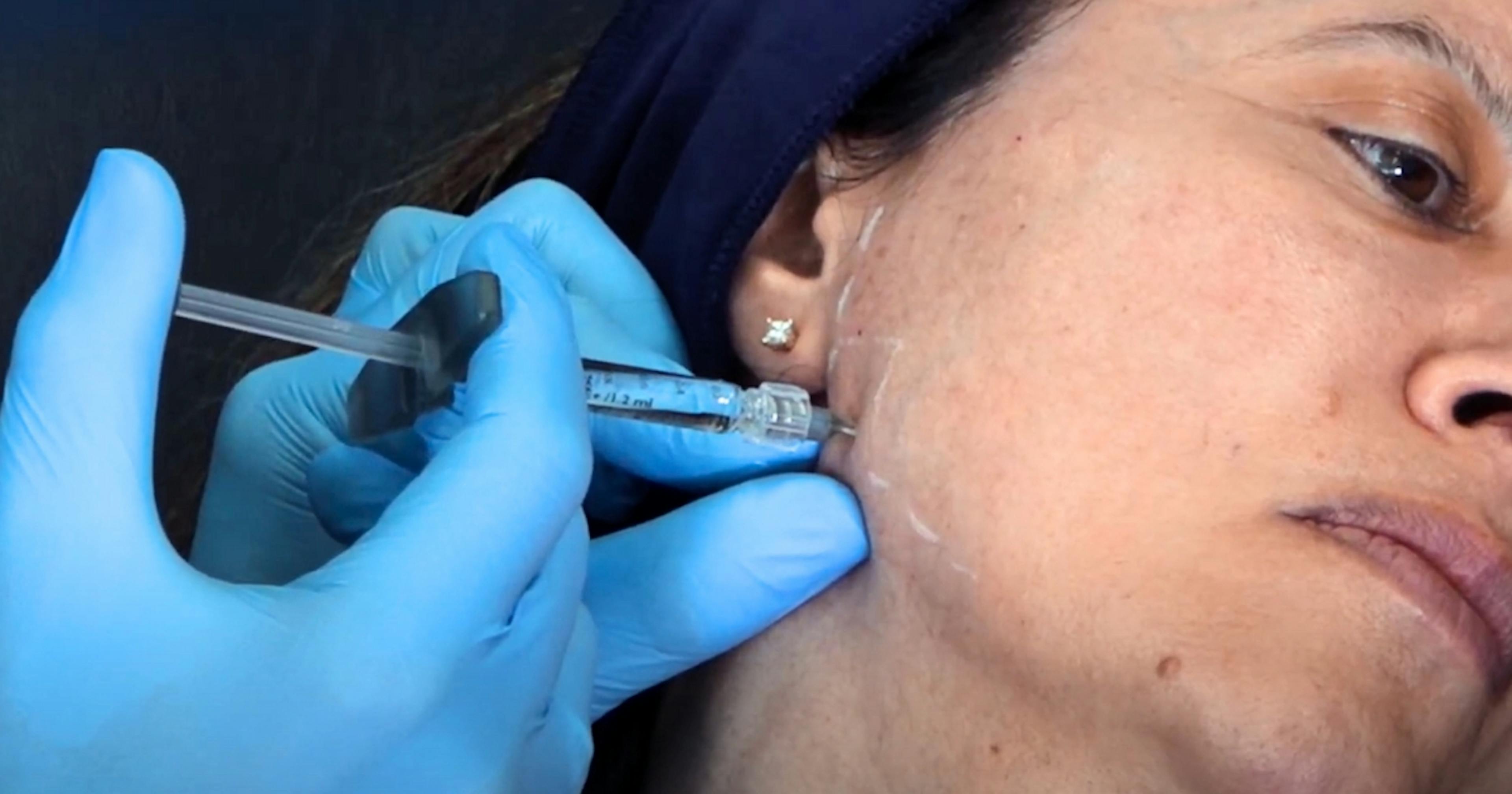 Jawline filler to add definition to jaw corners