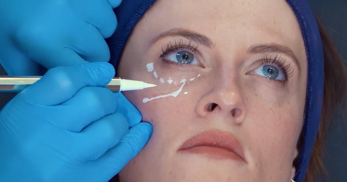 Marking up for tear trough filler - Harley Academy tear trough filler course