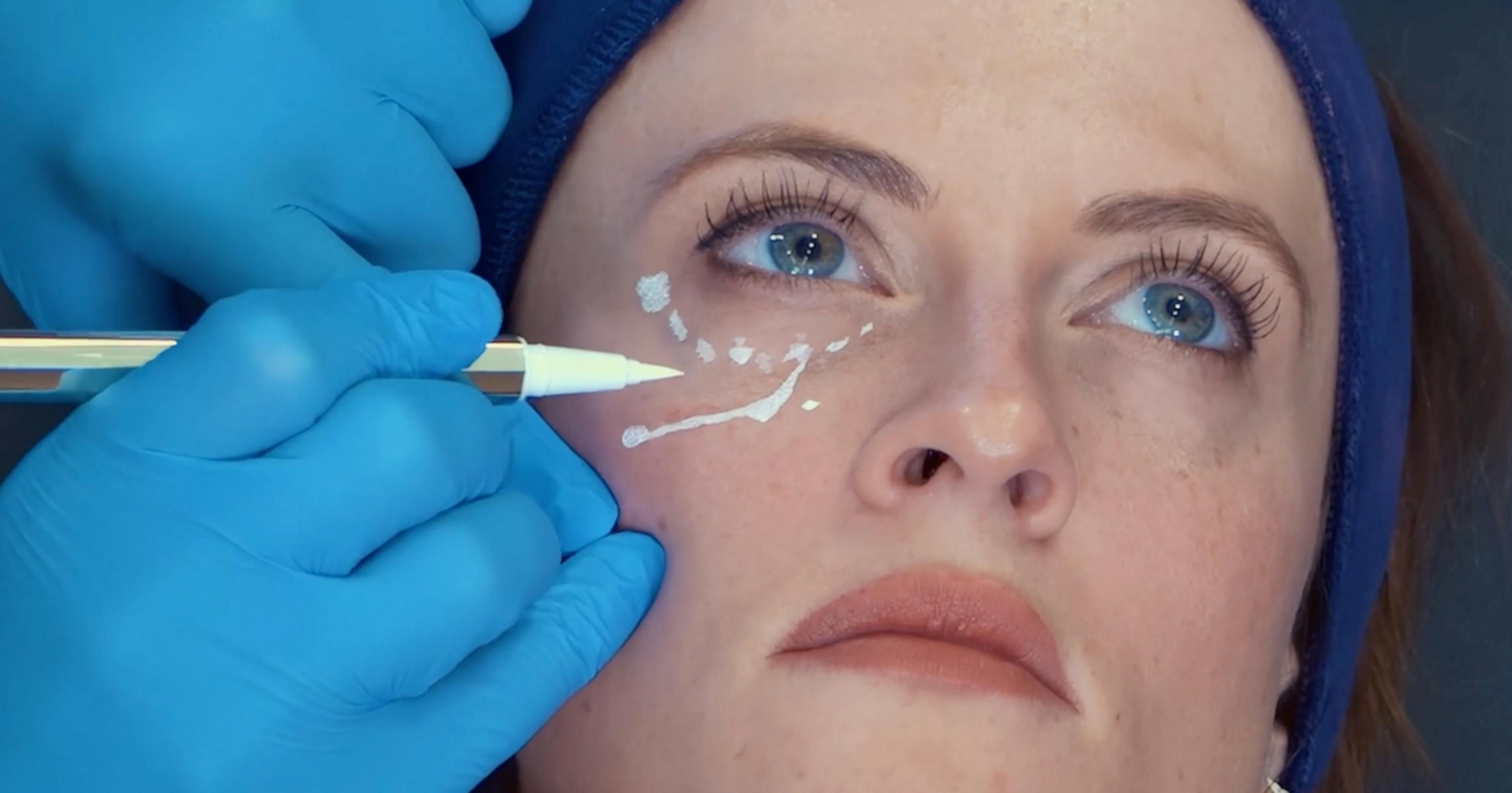 Marking up for tear trough filler - Harley Academy tear trough filler course
